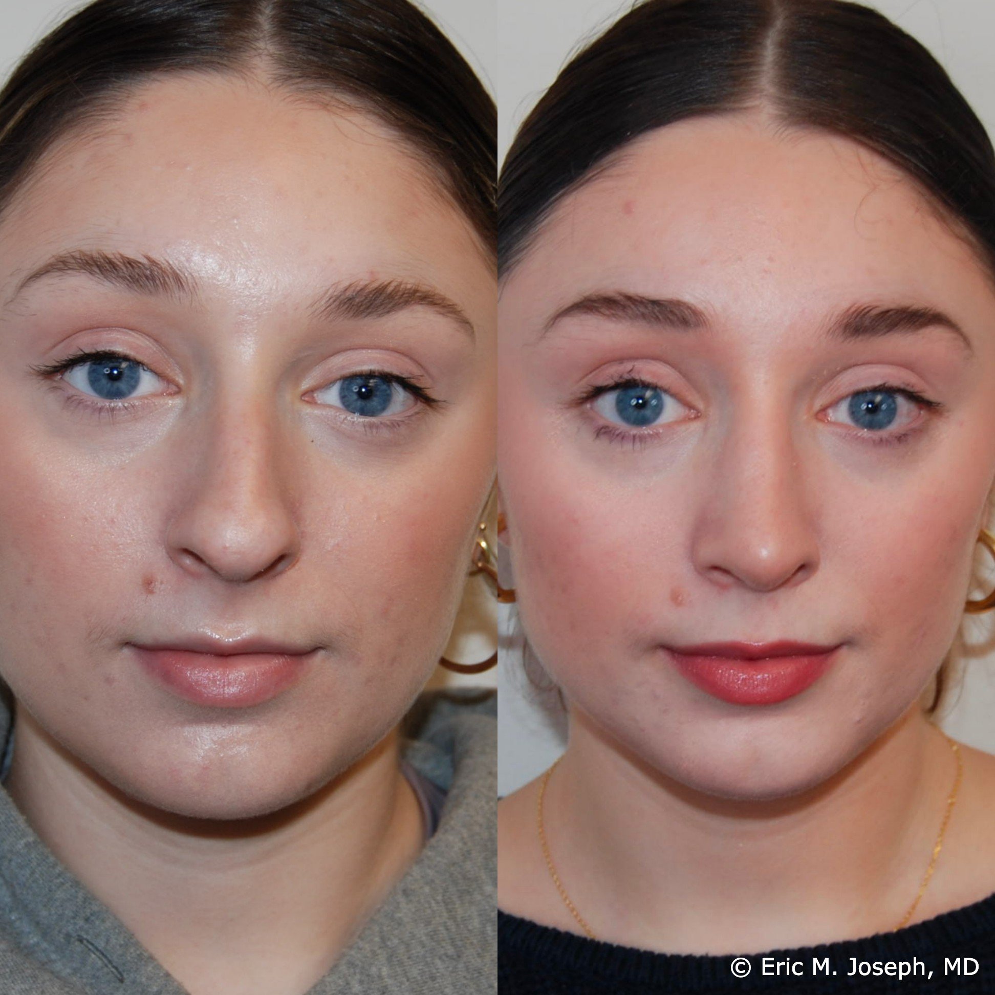 Case #17654 - Natural Results Plastic Surgery