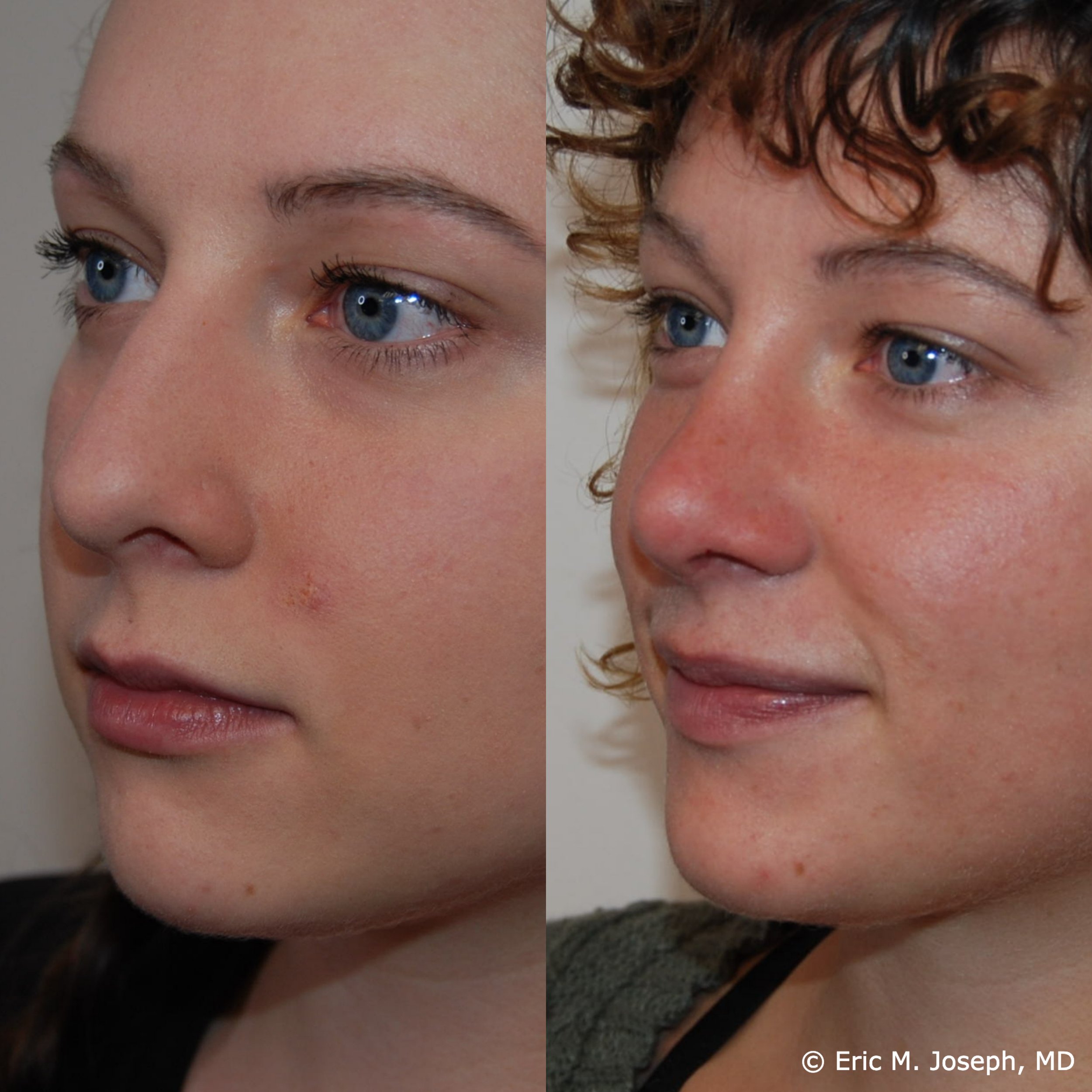 primary-rhinoplasty-nj1455.jpg