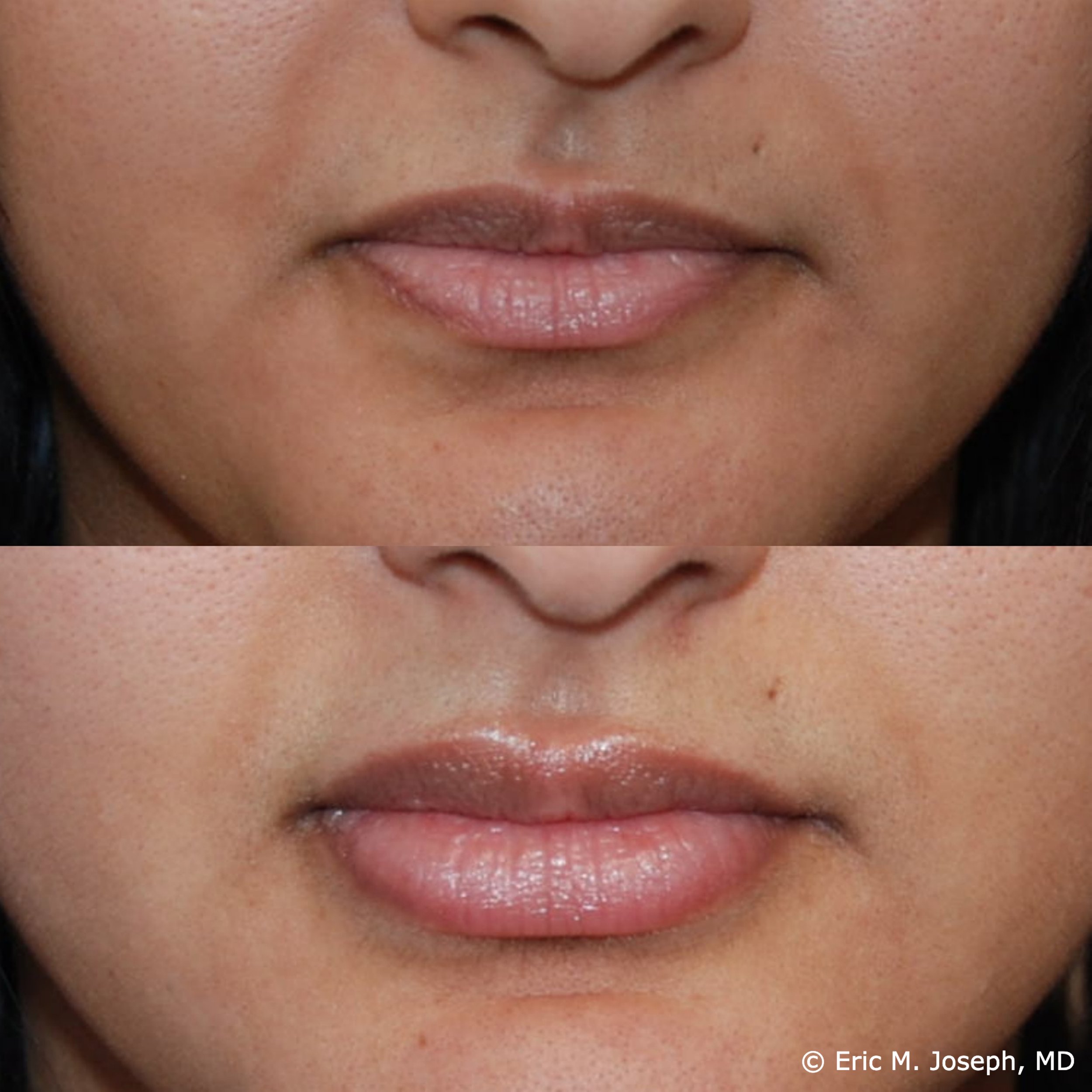 lip-augmentation-permanent-filler-nj-0088.jpg