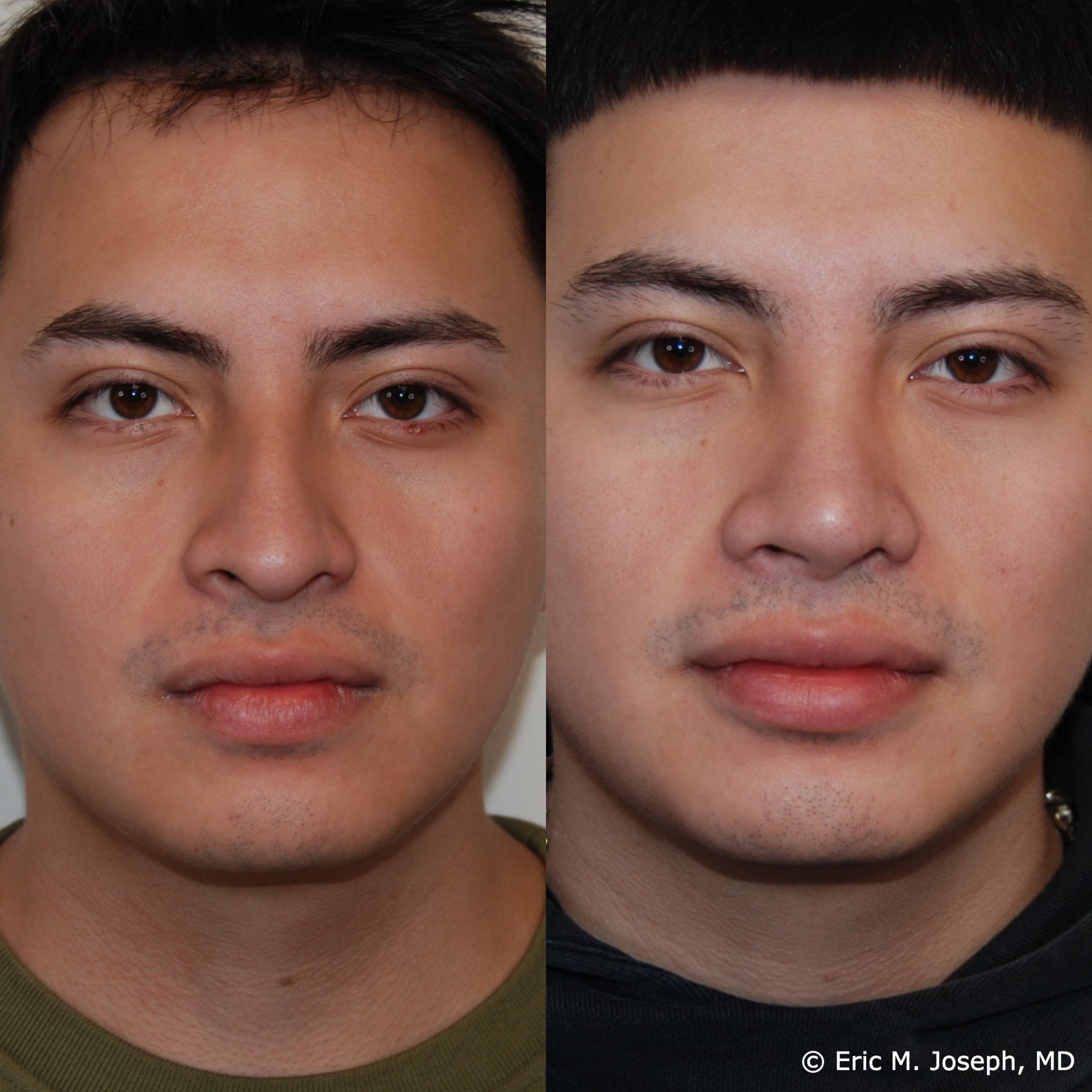 primary-rhinoplasty-nj1464.jpg