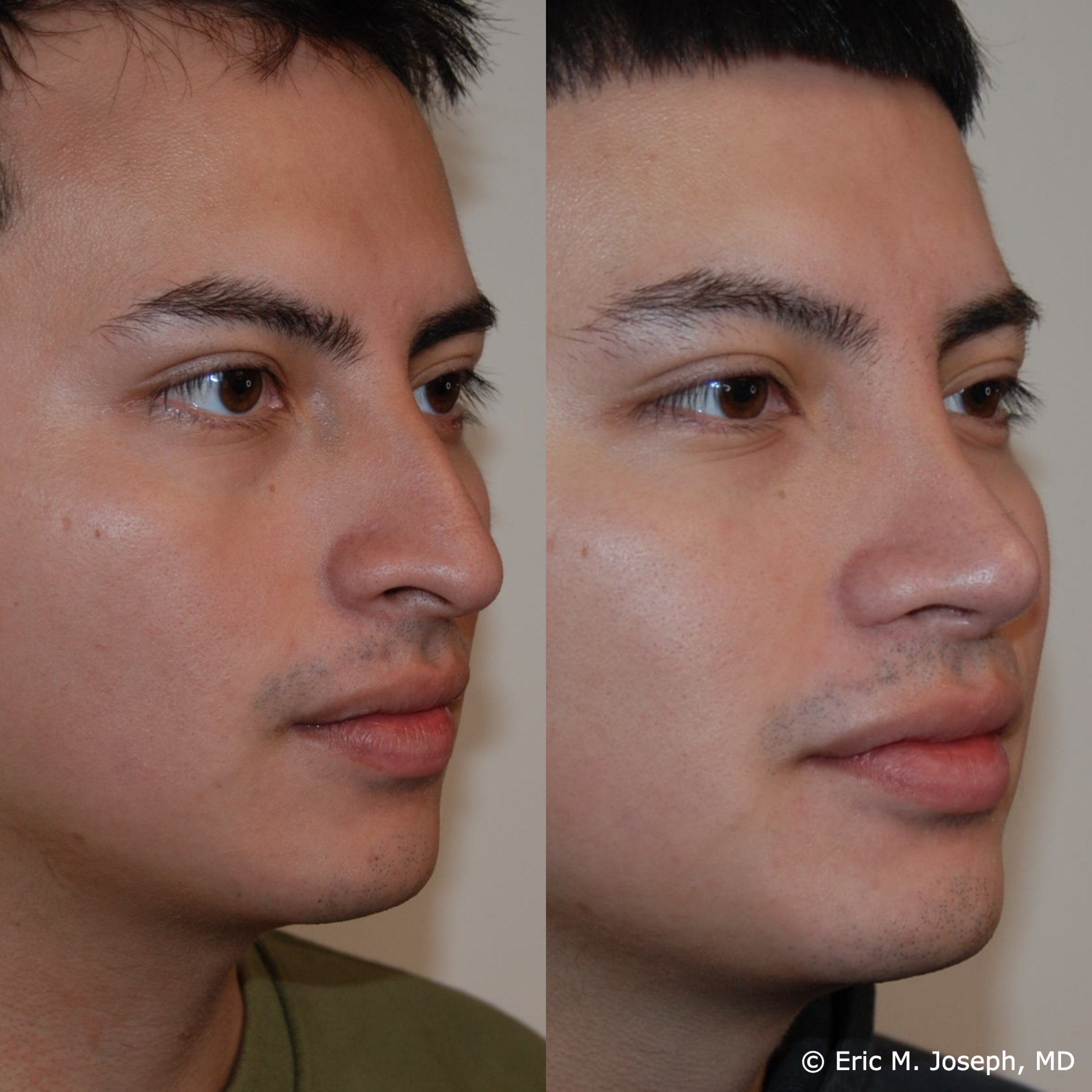 primary-rhinoplasty-nj1462.jpg