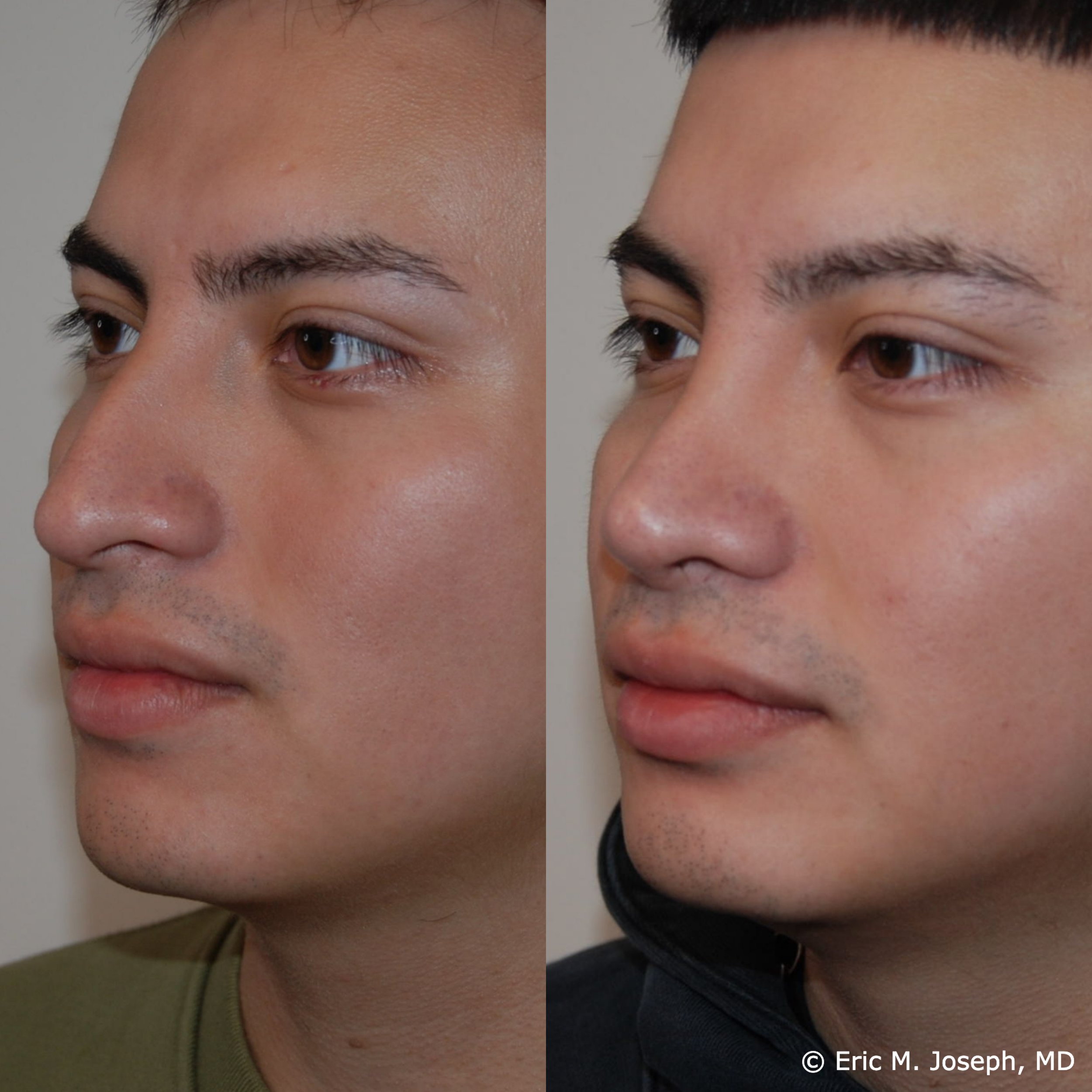 primary-rhinoplasty-nj1459.jpg