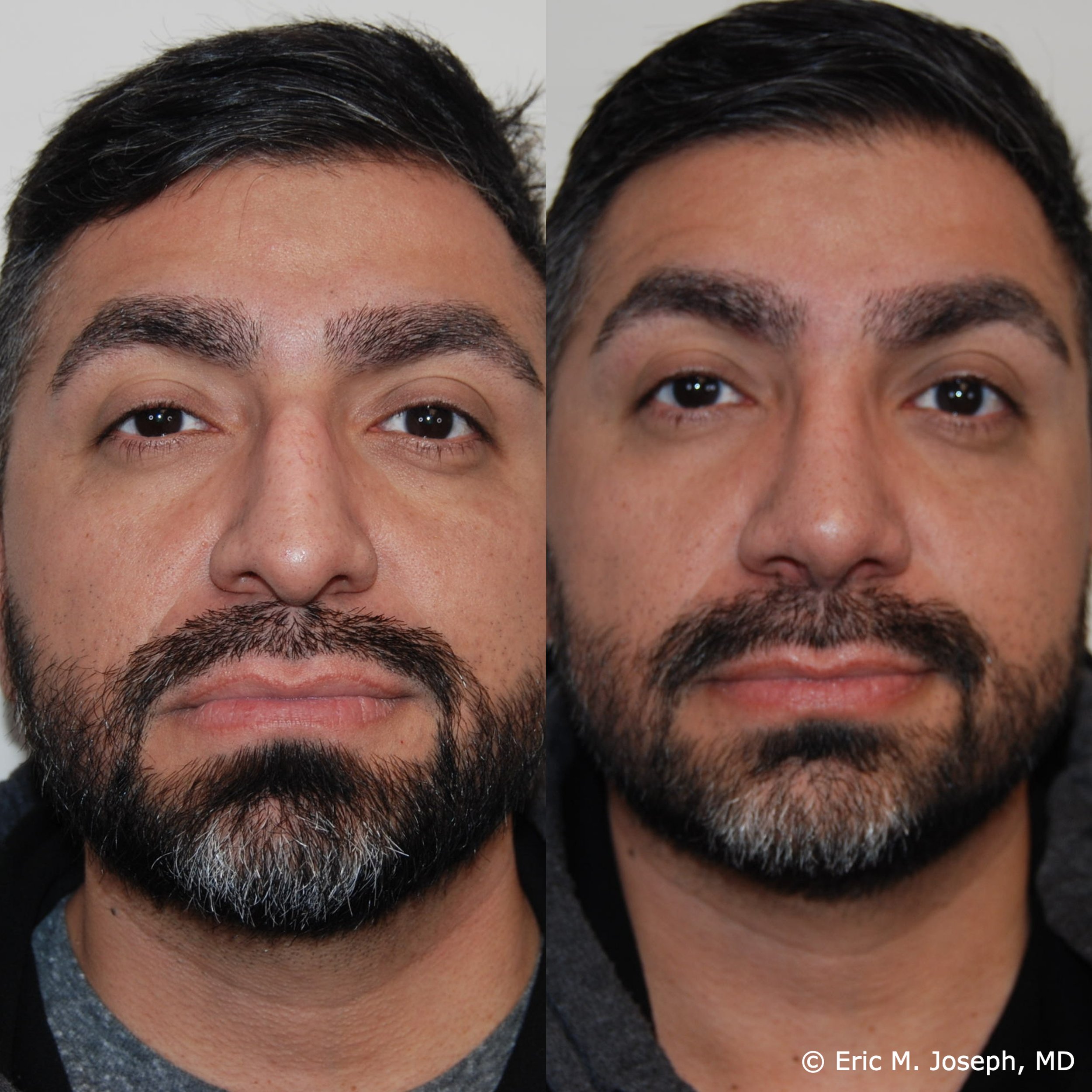 primary-rhinoplasty-nj1472.jpg