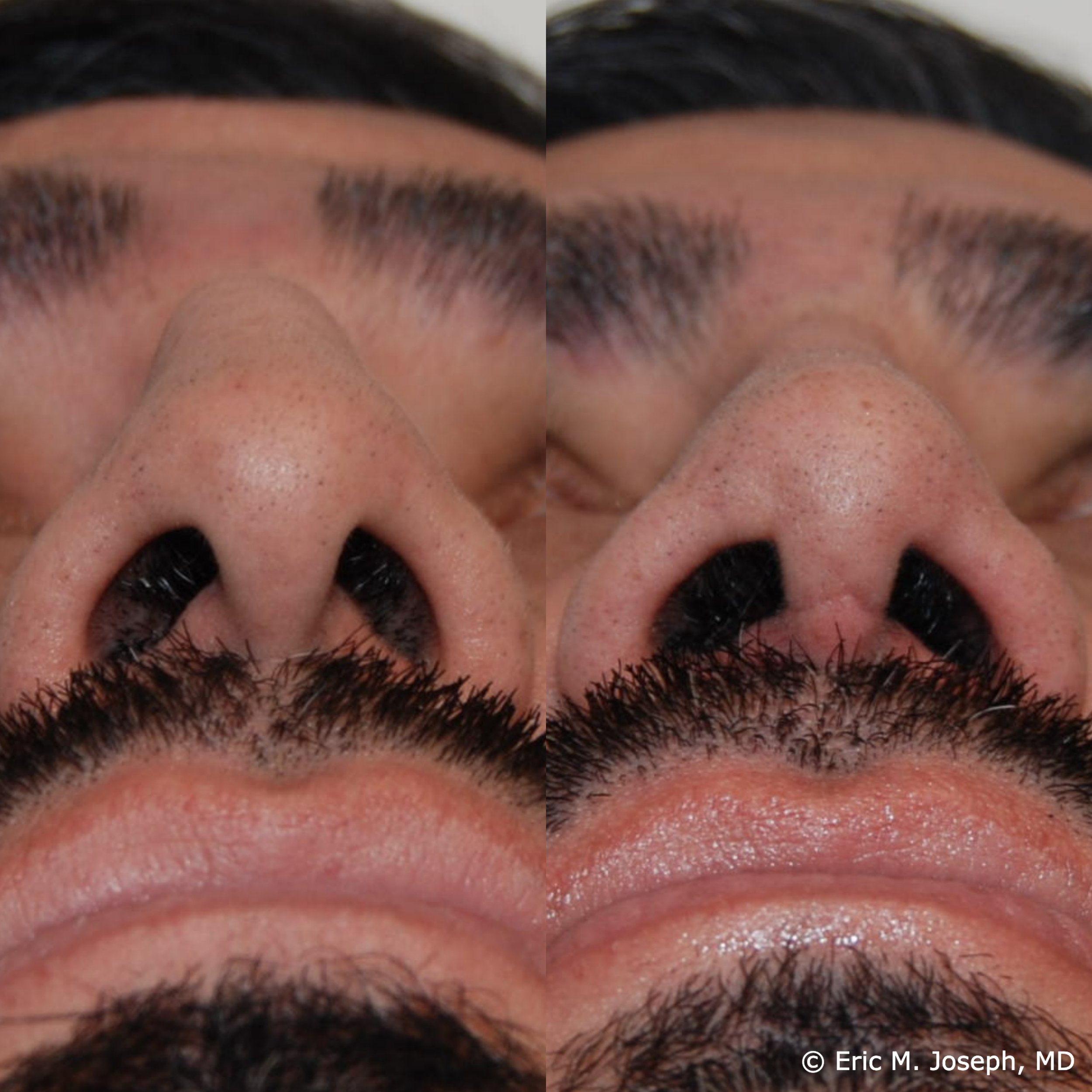 primary-rhinoplasty-nj1470.jpg