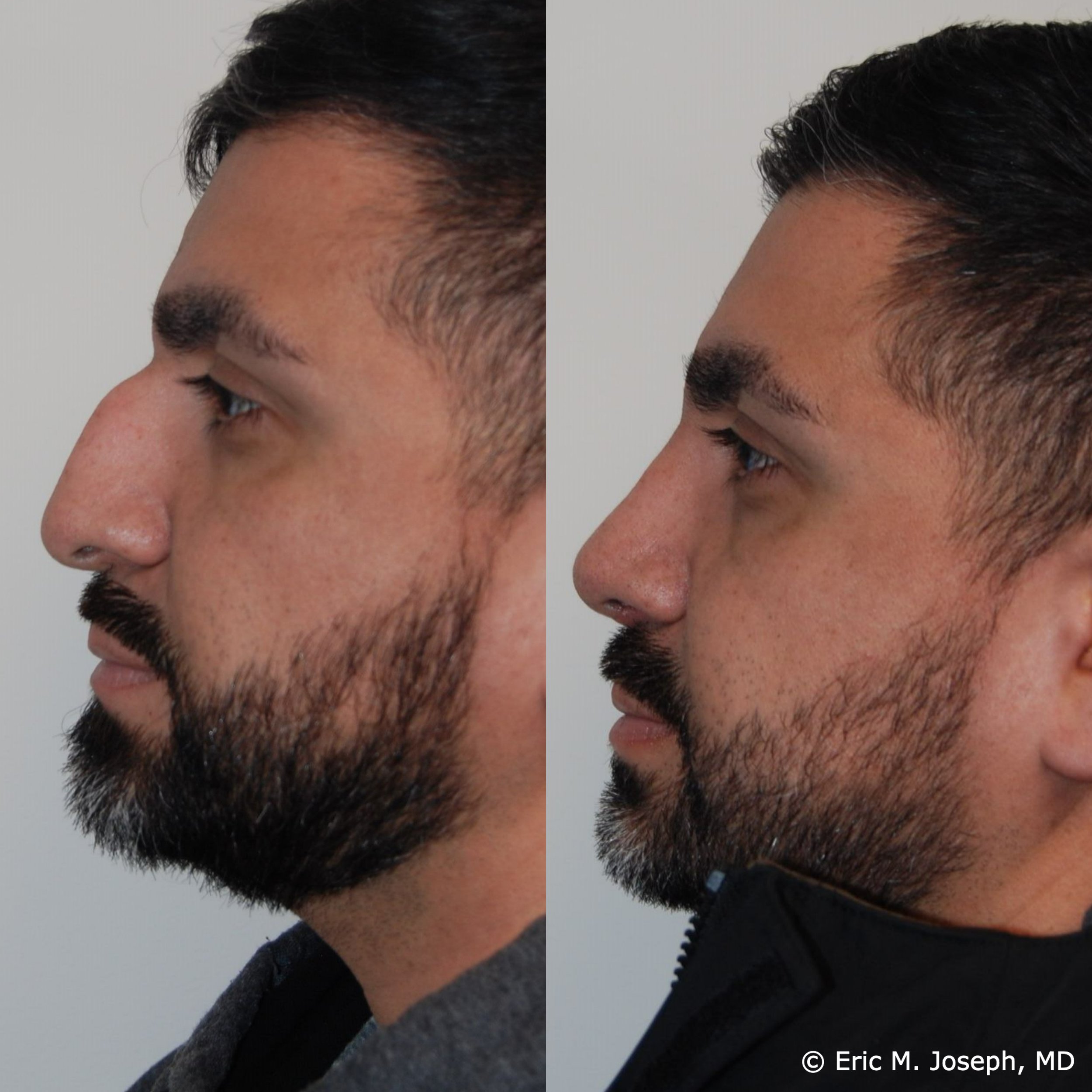 primary-rhinoplasty-nj1468.jpg