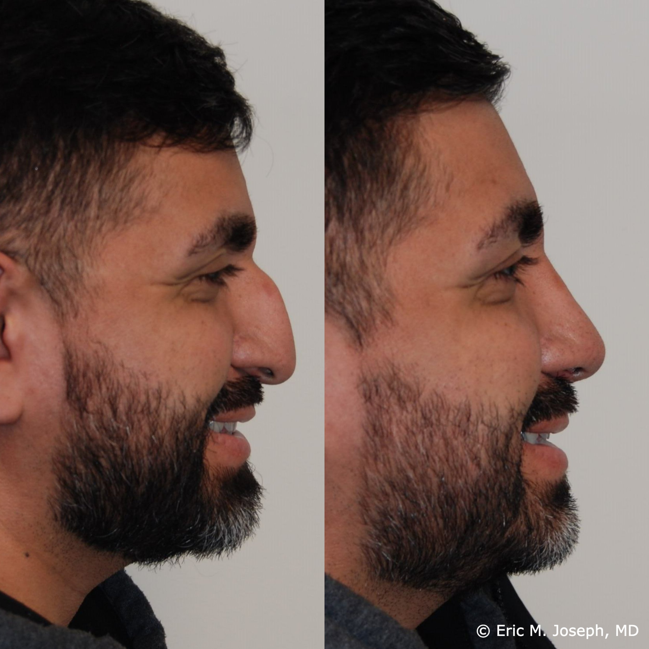 primary-rhinoplasty-nj1466.jpg