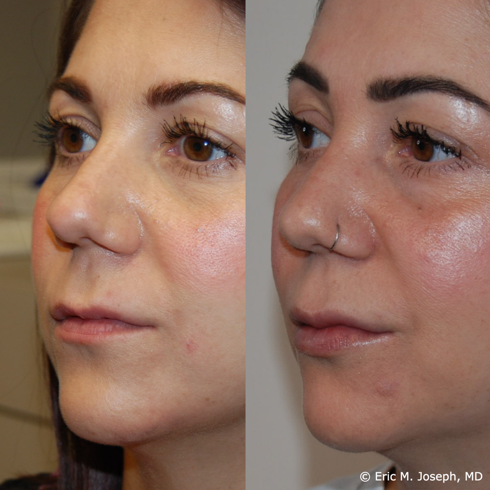 Eric M. Joseph, MD | Lip Augmentation Before & After: Three