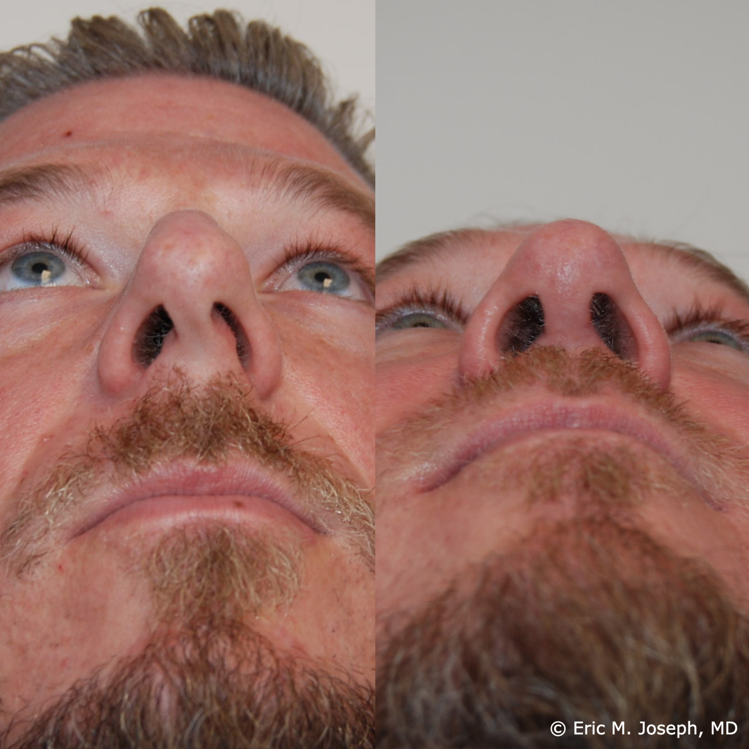 Eric M Joseph MD Rhinoplasty Before After Deviated Septum Eric M Joseph MD Rhinoplasty Before After Deviated Septum