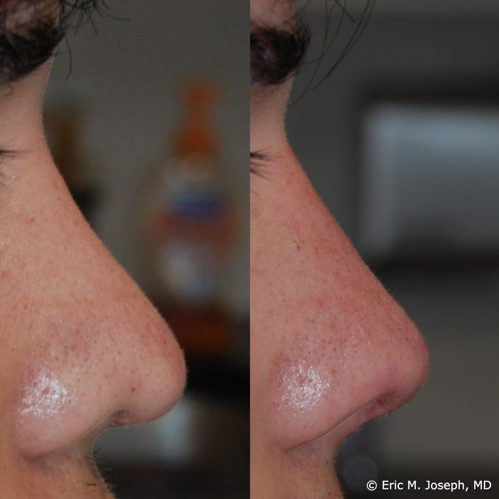 Eric M. Joseph, MD | Permanent Non Surgical Rhinoplasty/ Nose Job