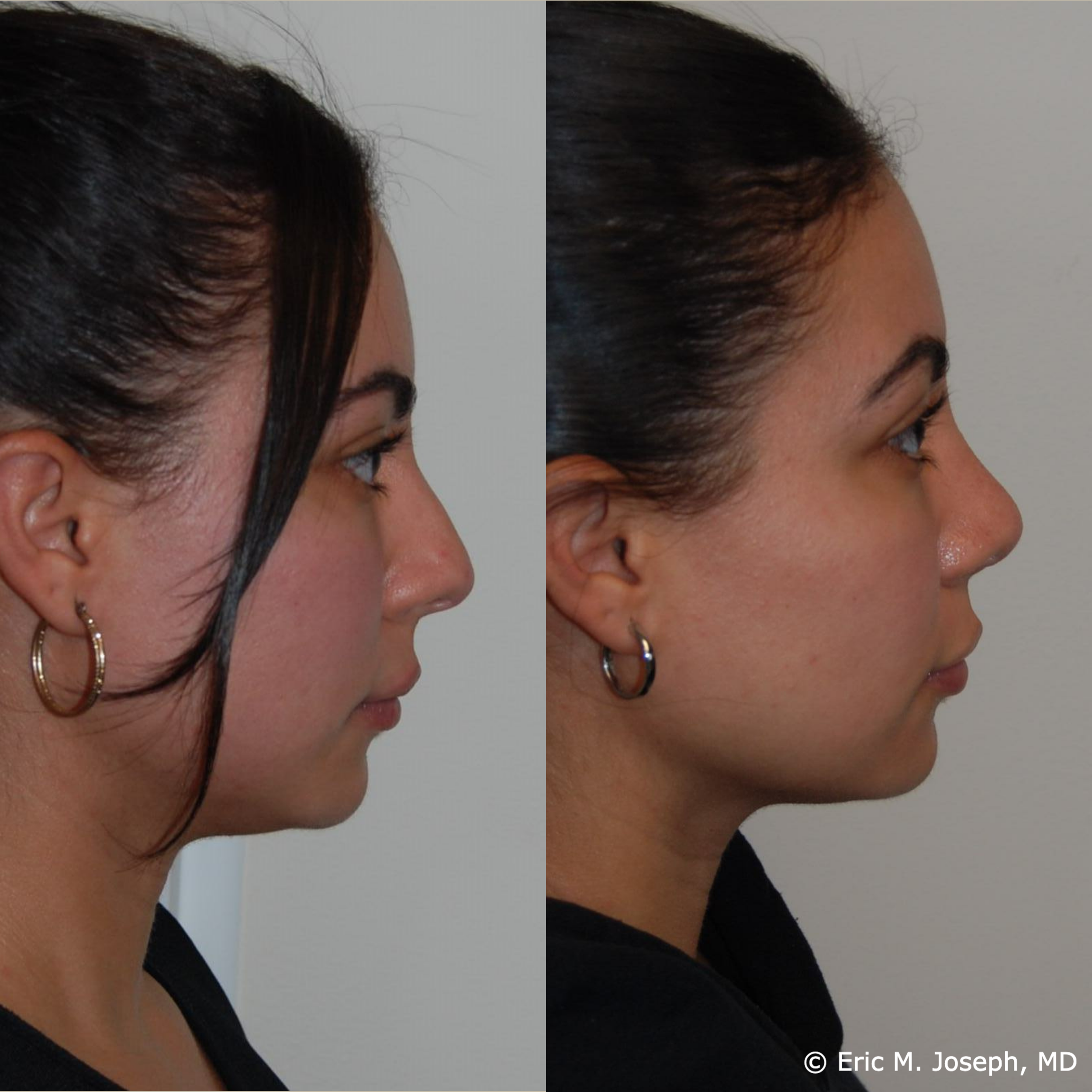 Eric M. Joseph, MD | Rhinoplasty Before & After: Overprojected, Droopy ...