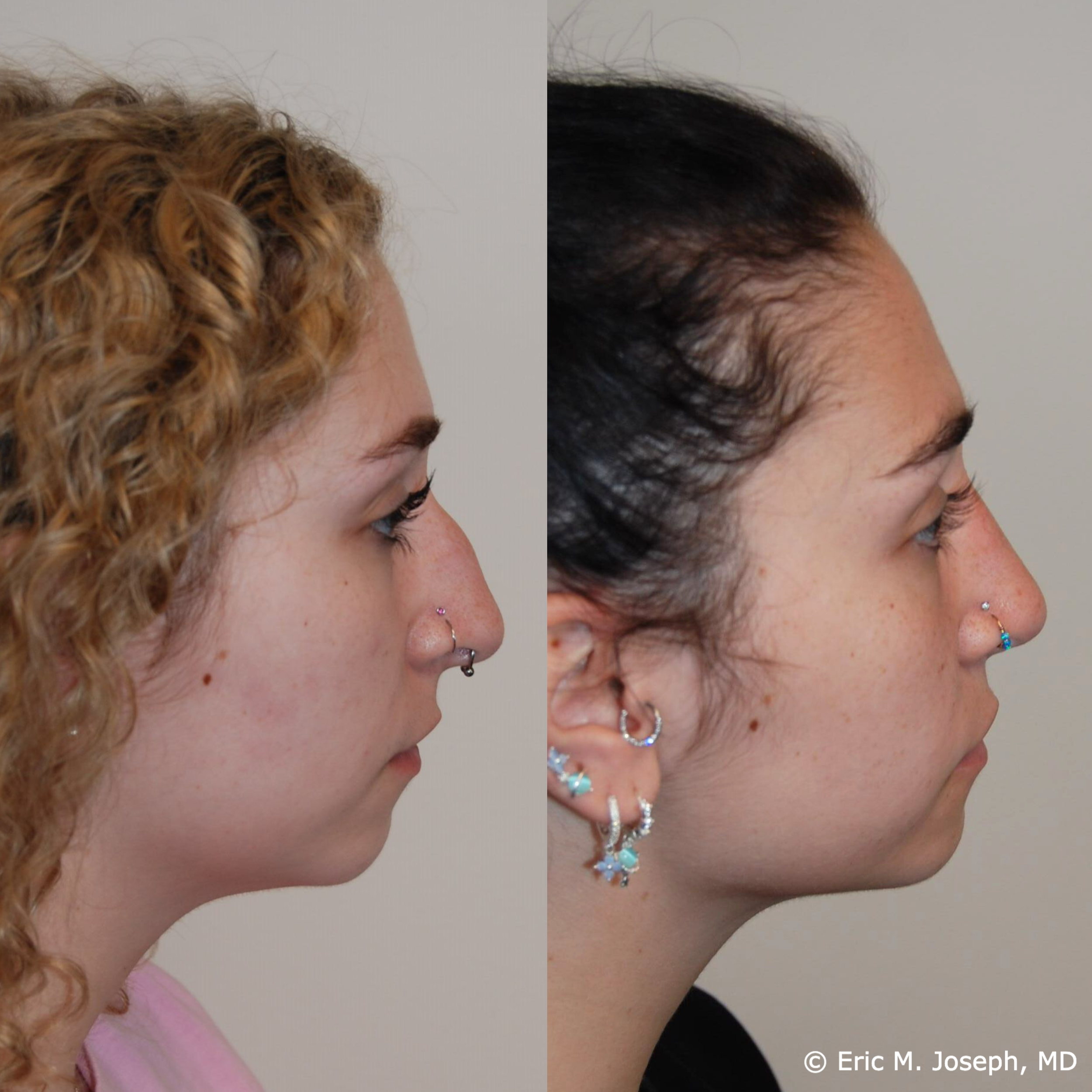 primary-rhinoplasty-nj656.png