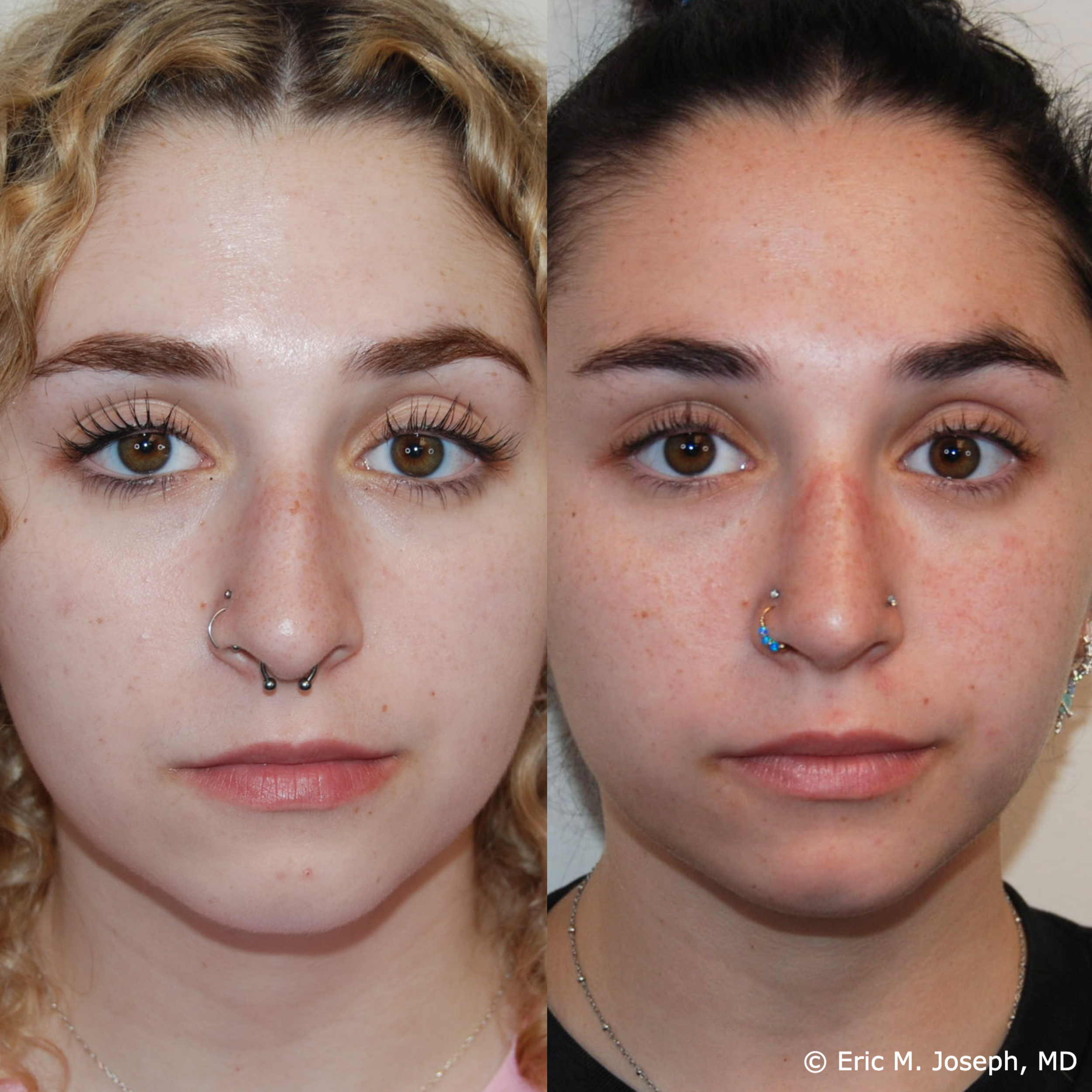 primary-rhinoplasty-nj657.png