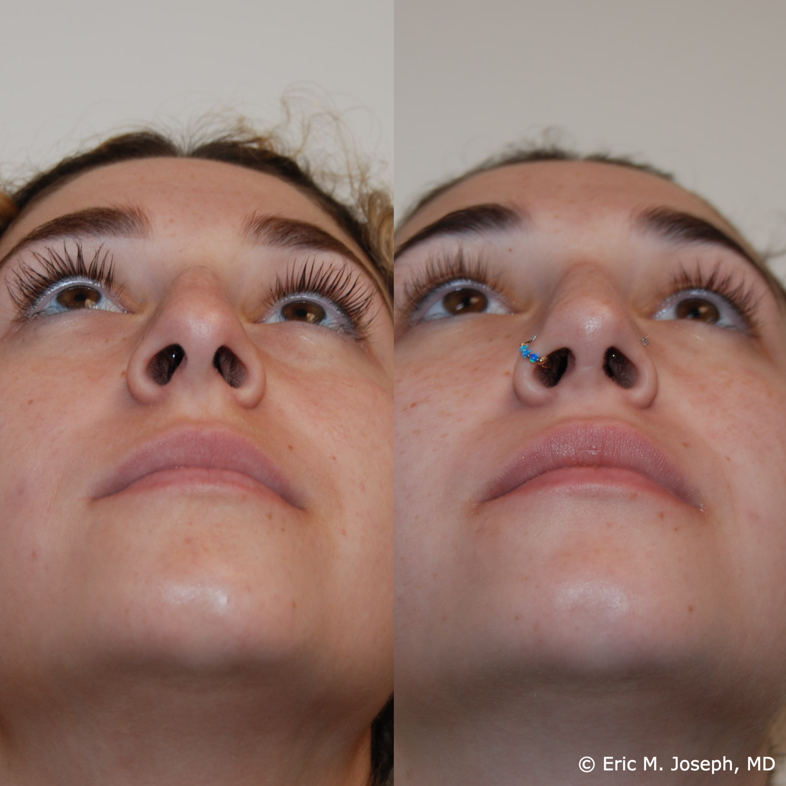 primary-rhinoplasty-nj659.png