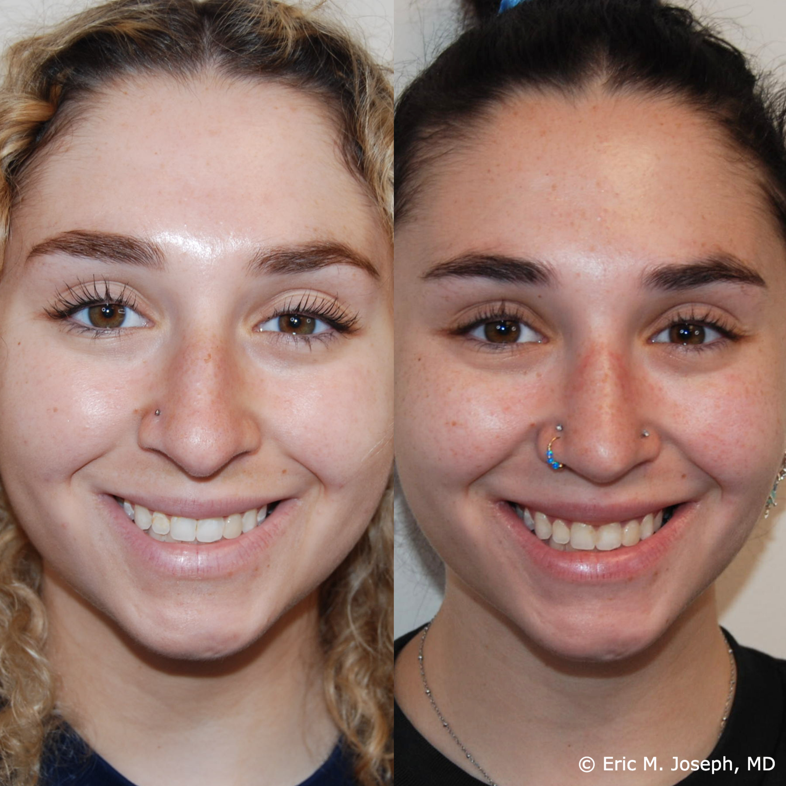 primary-rhinoplasty-nj658.png