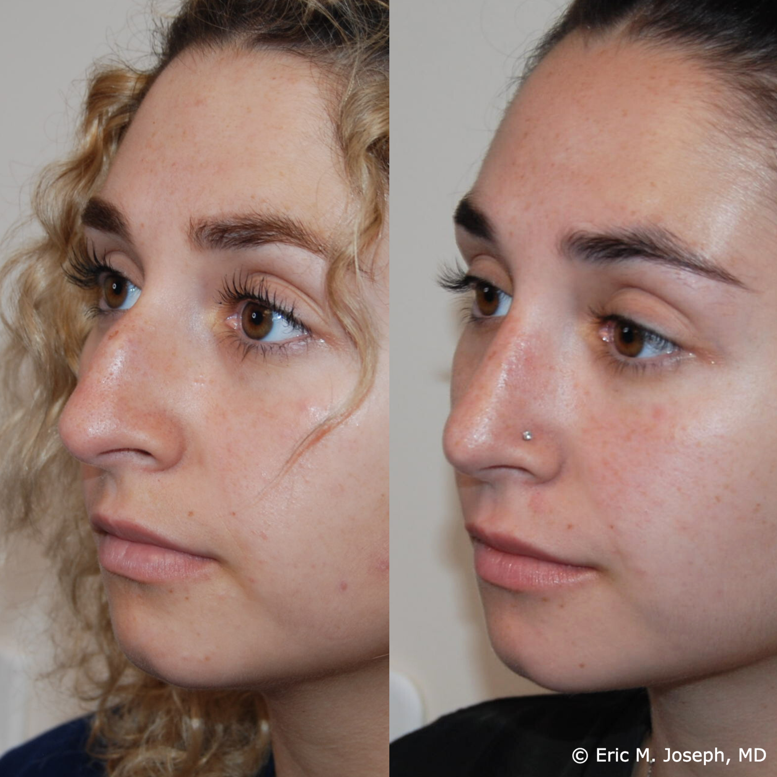 primary-rhinoplasty-nj661.png