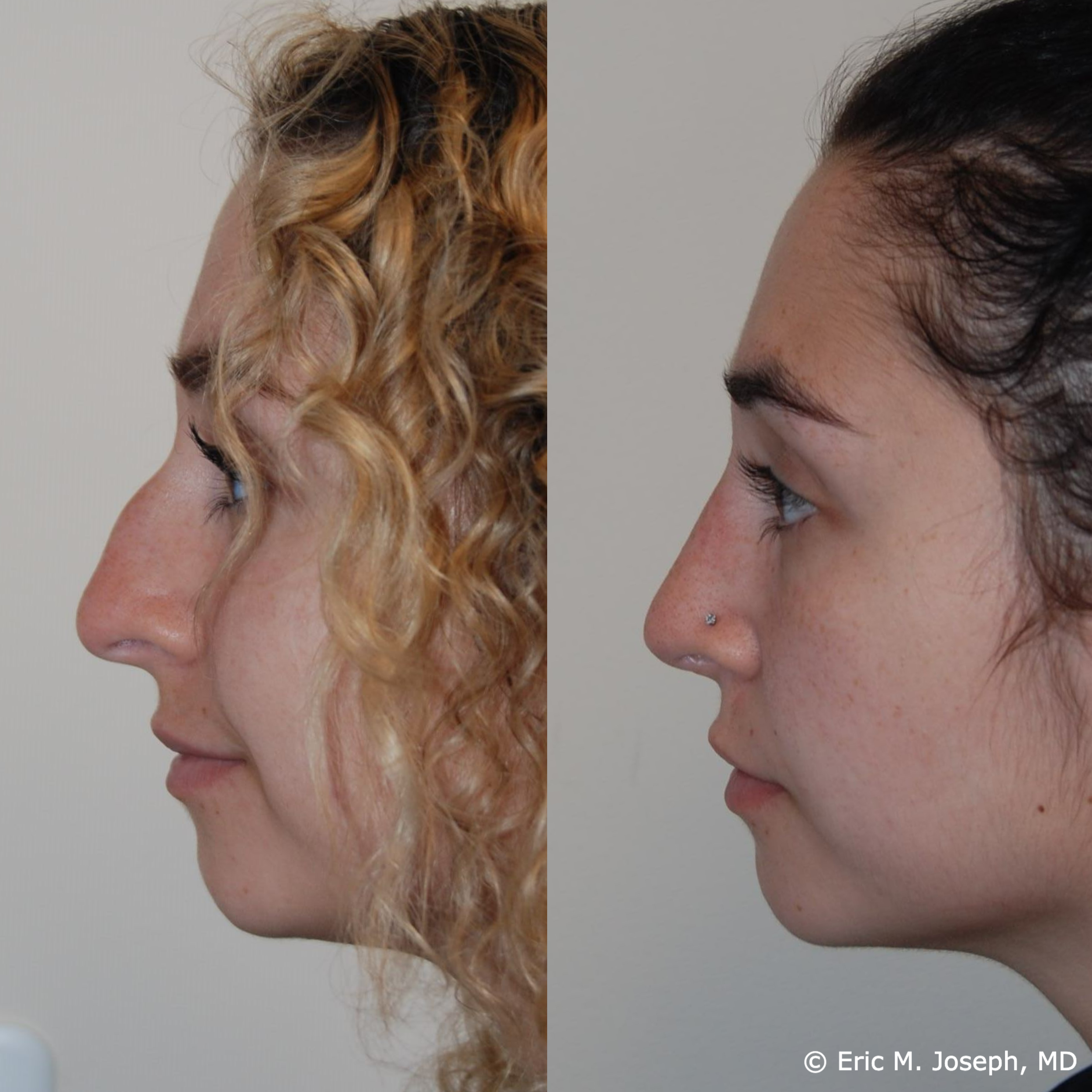primary-rhinoplasty-nj662.png