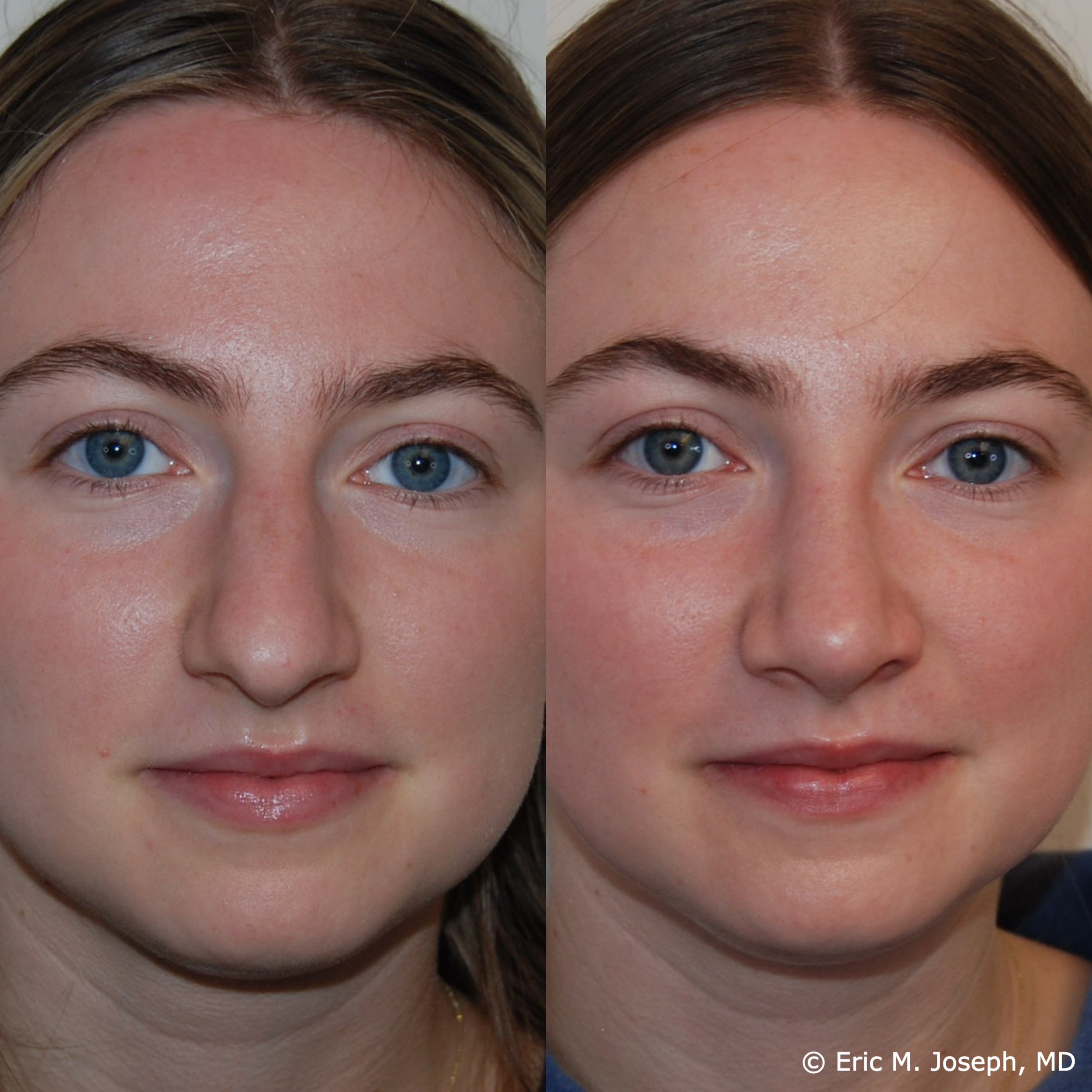 primary-rhinoplasty-nj663.png