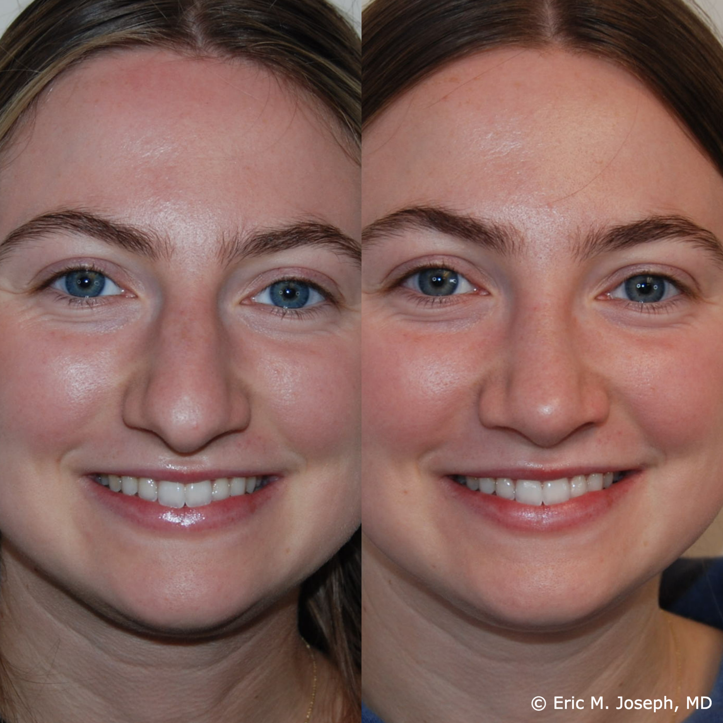 primary-rhinoplasty-nj664.png