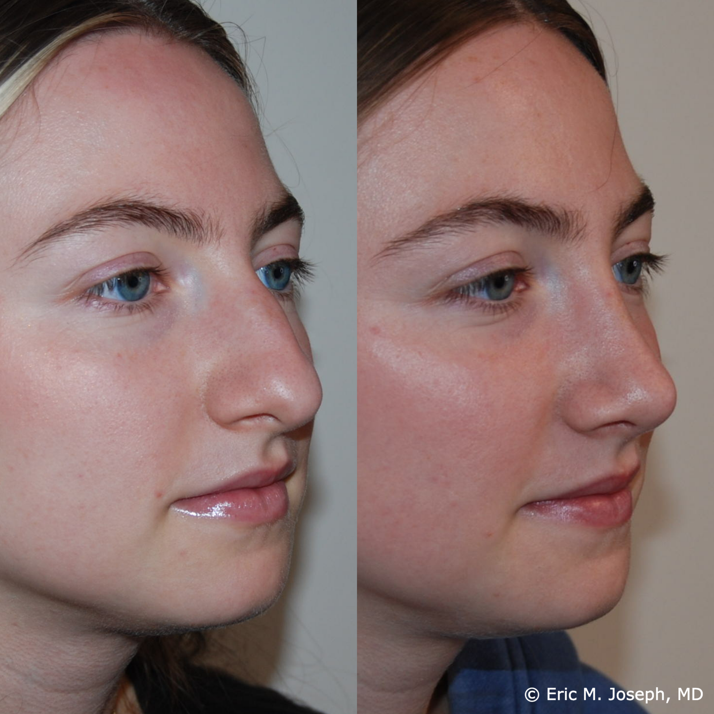 primary-rhinoplasty-nj665.png