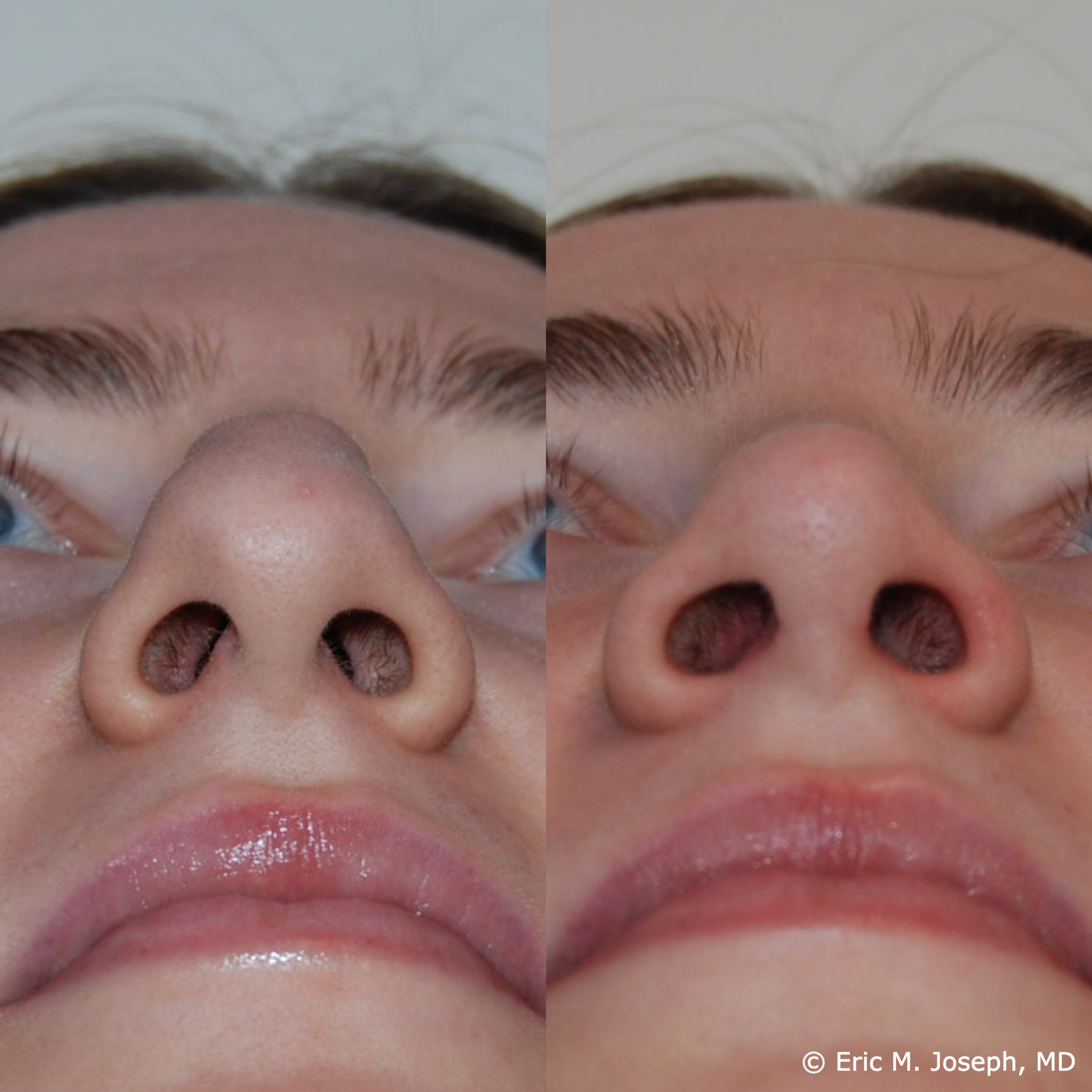 primary-rhinoplasty-nj666.png
