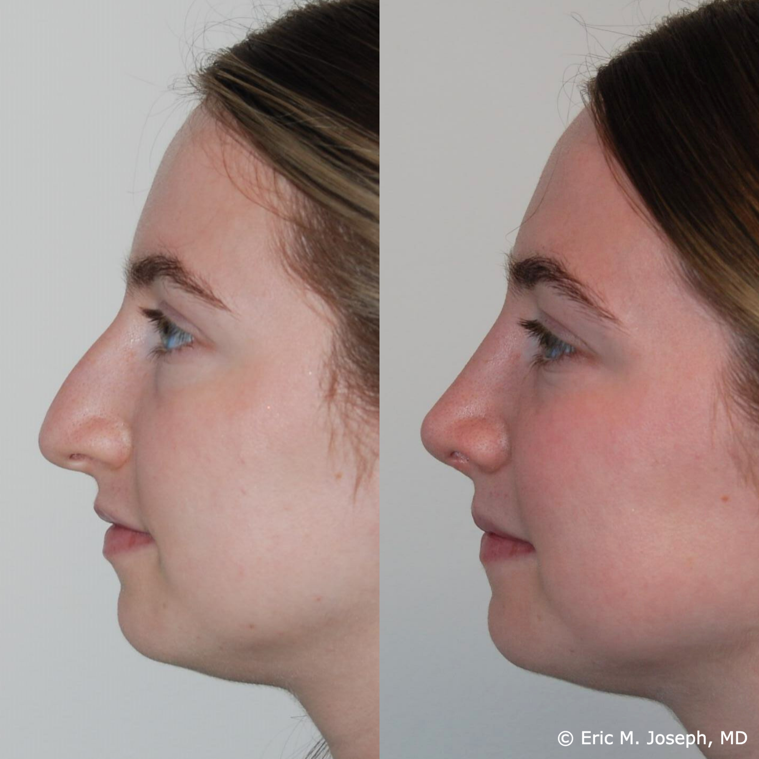 primary-rhinoplasty-nj667.png