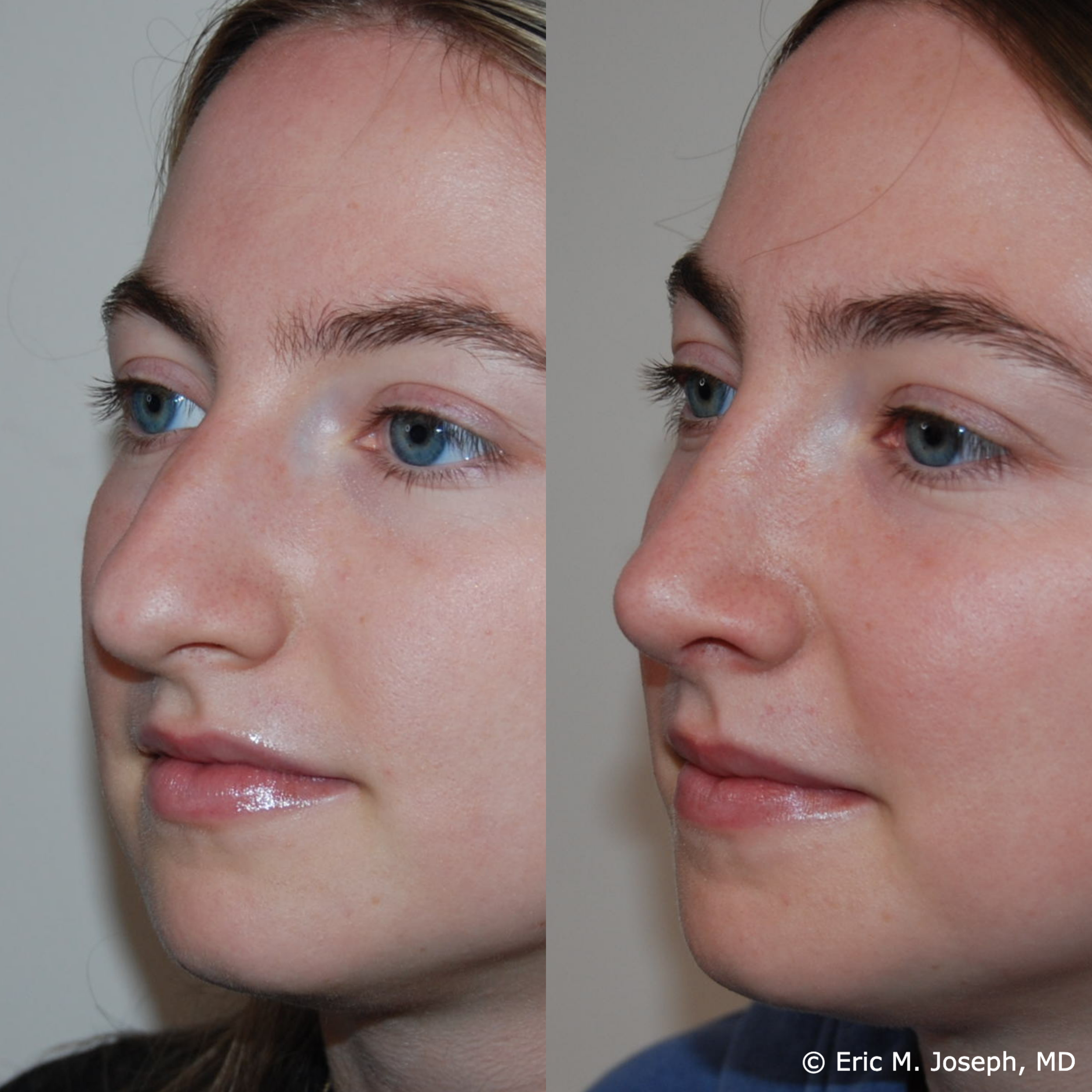 primary-rhinoplasty-nj668.png