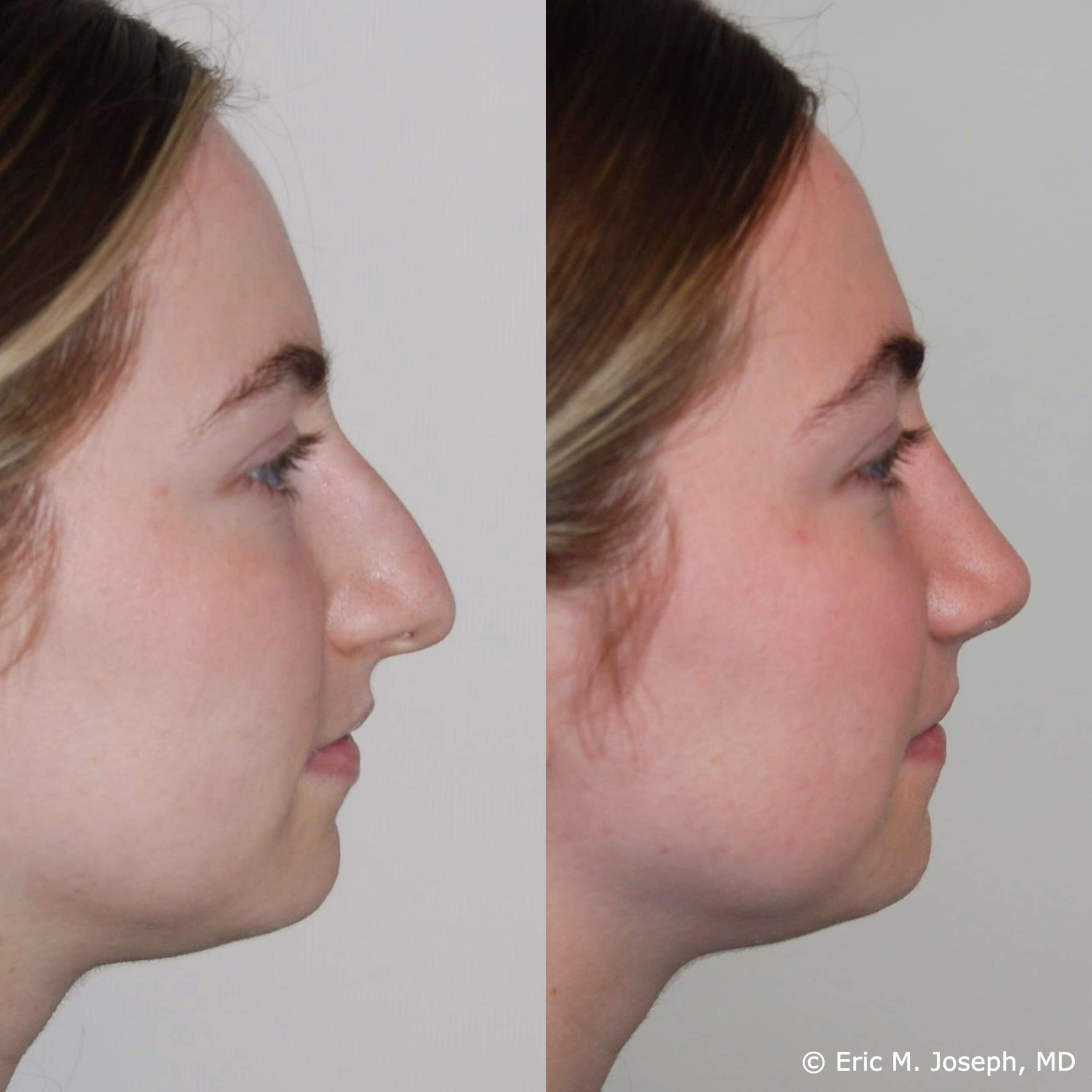 primary-rhinoplasty-nj670.png