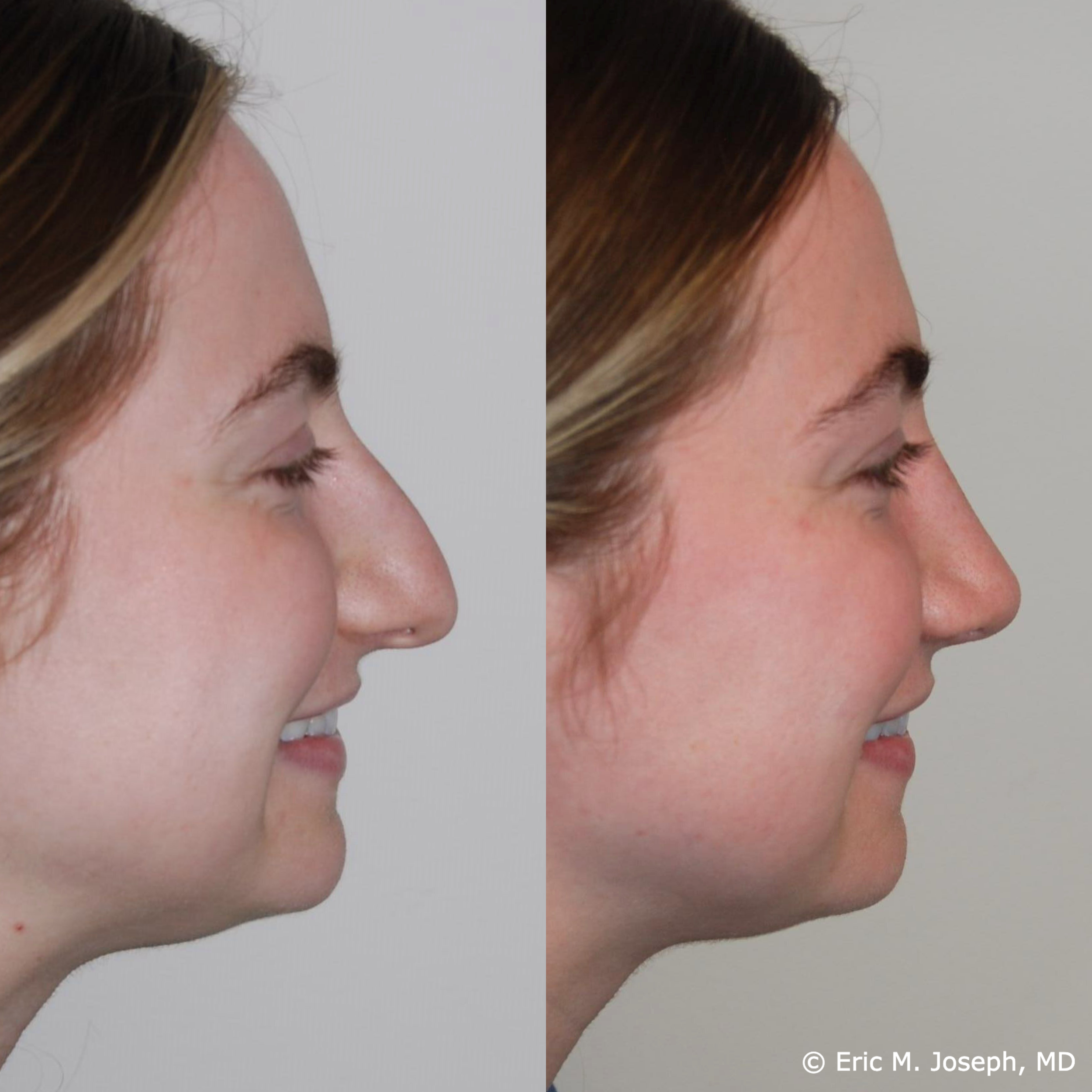 primary-rhinoplasty-nj669.png