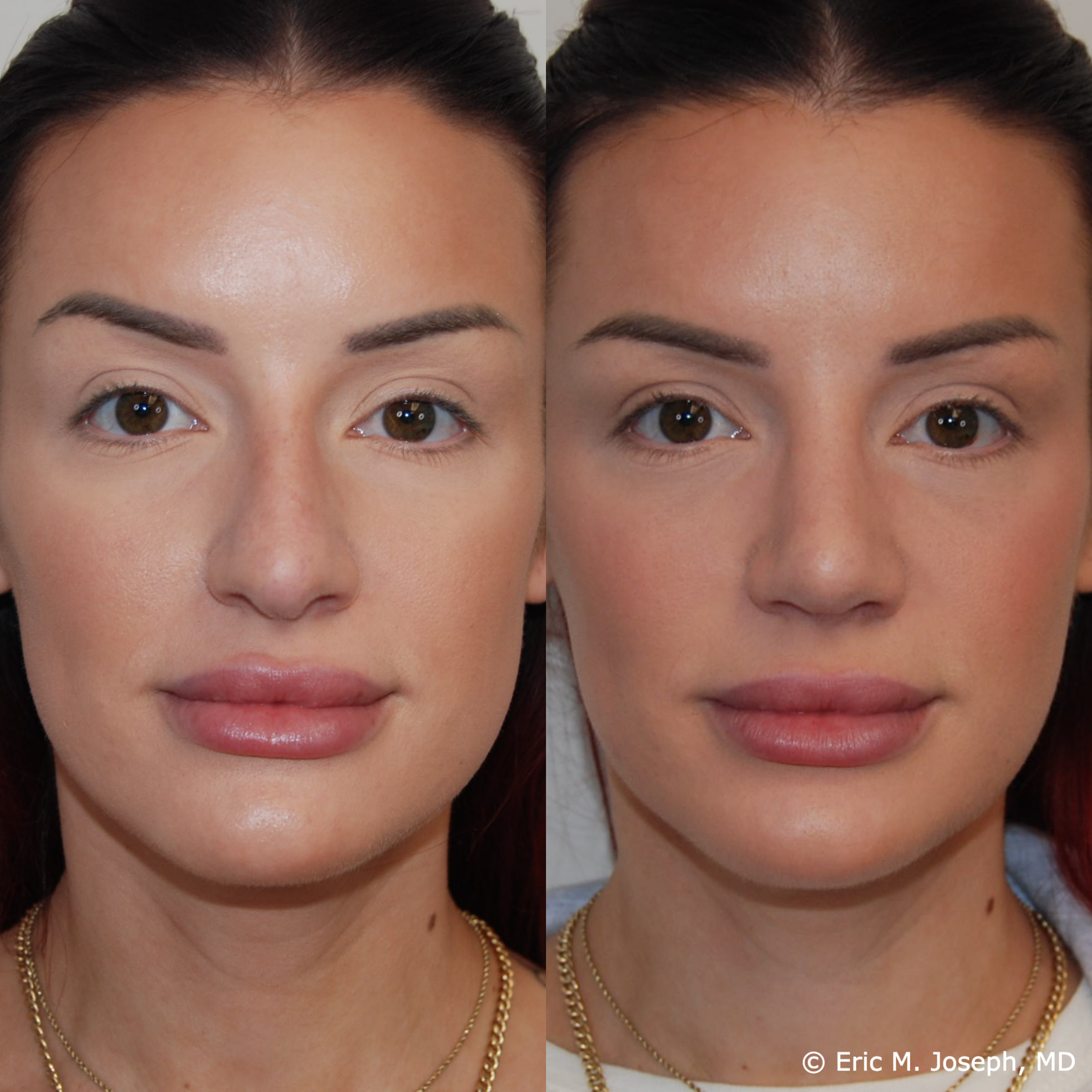primary-rhinoplasty-nj672.png