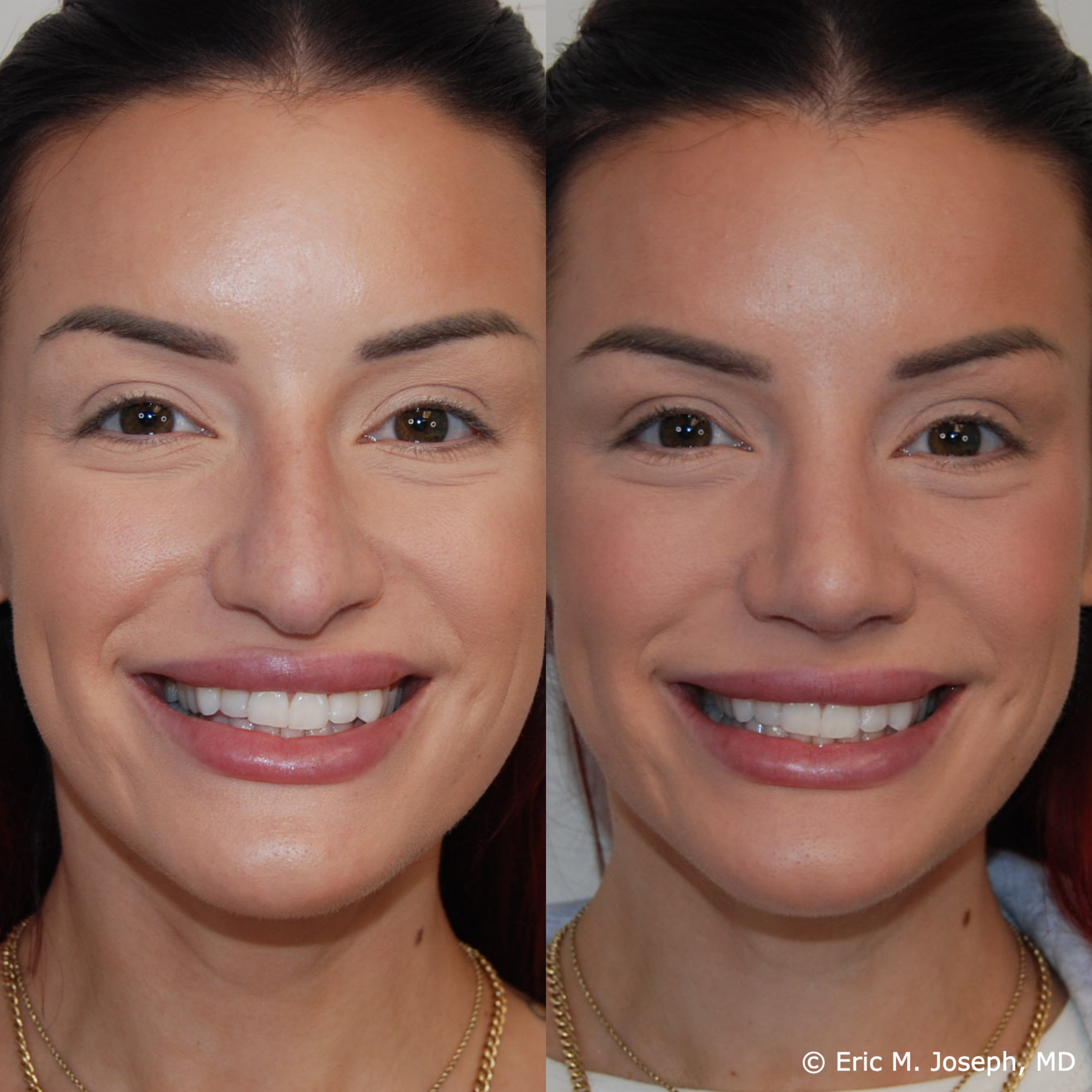primary-rhinoplasty-nj671.png