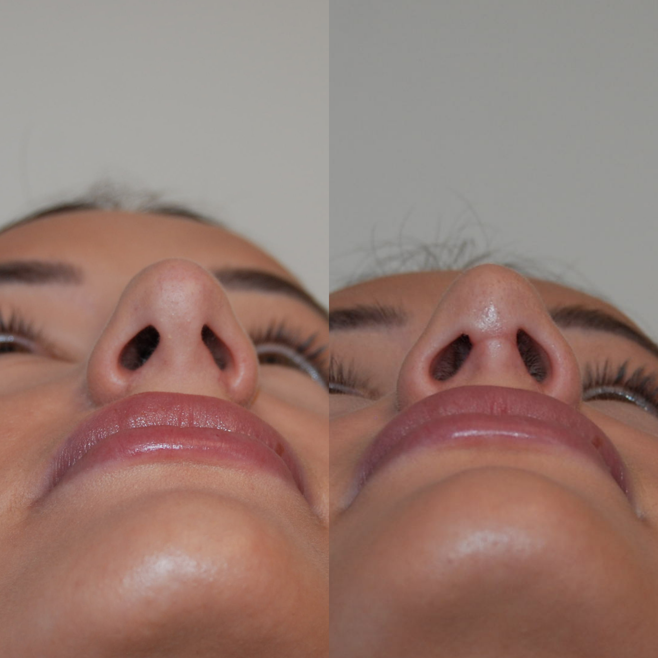 primary-rhinoplasty-nj673.png
