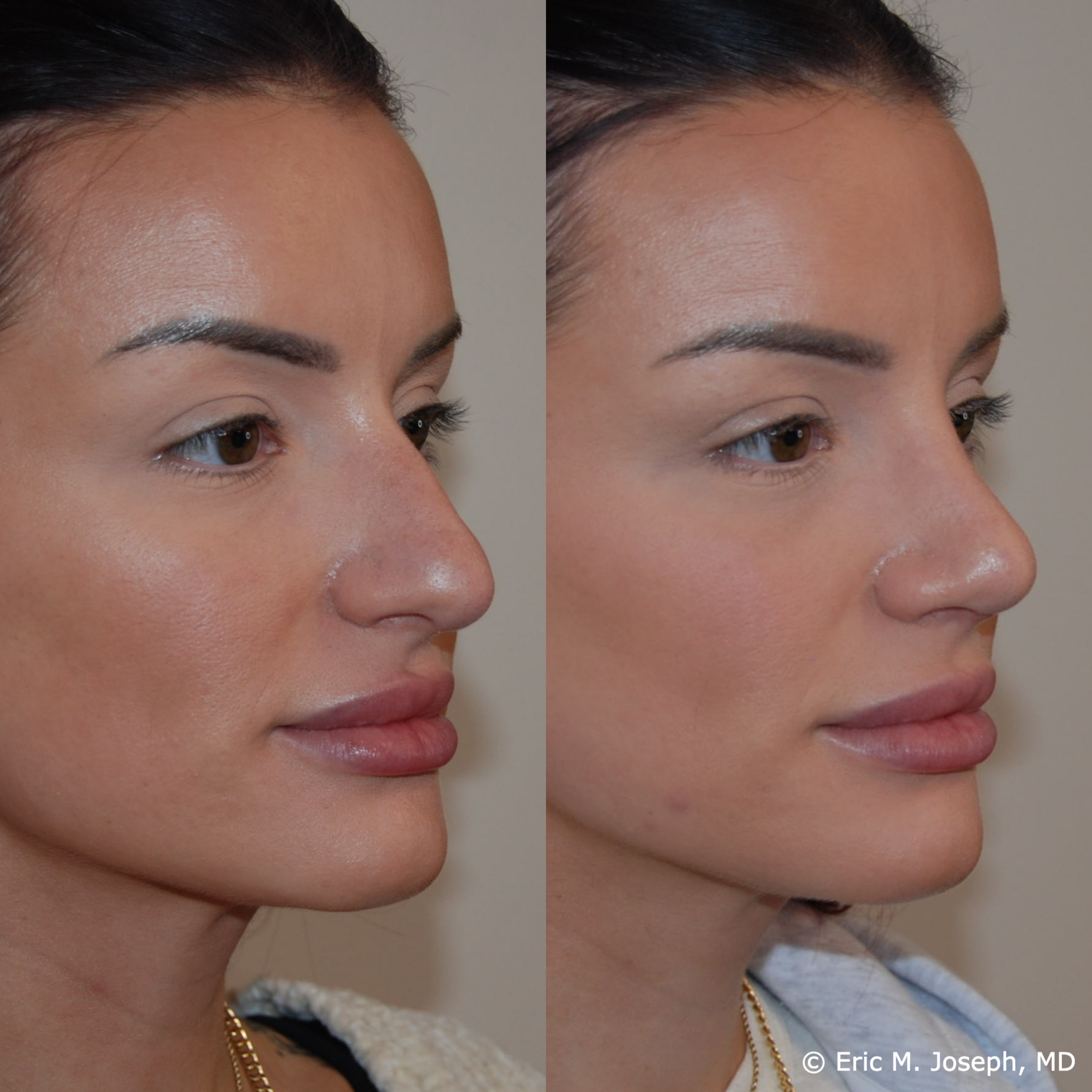 primary-rhinoplasty-nj674.png