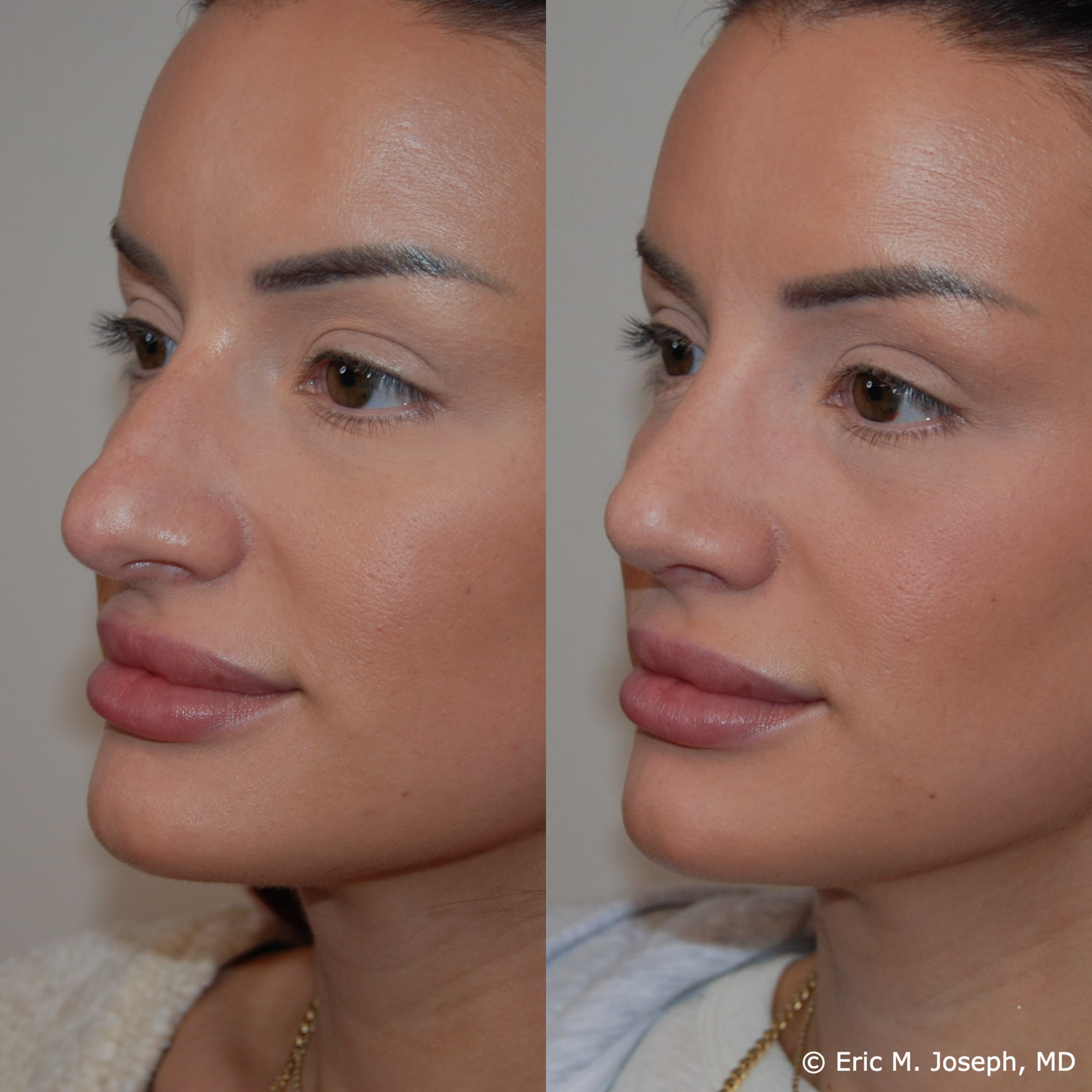 primary-rhinoplasty-nj675.png