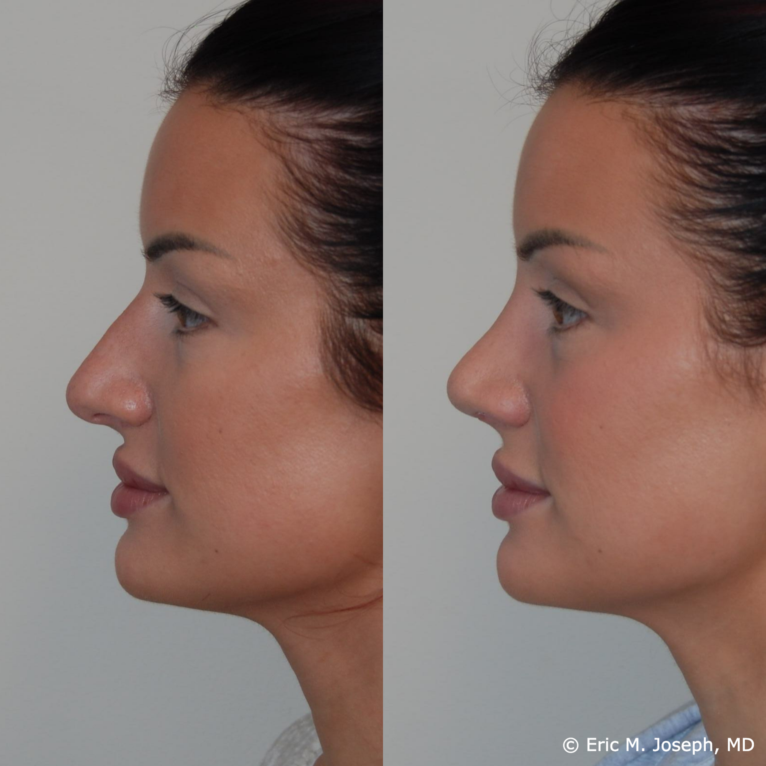 primary-rhinoplasty-nj676.png