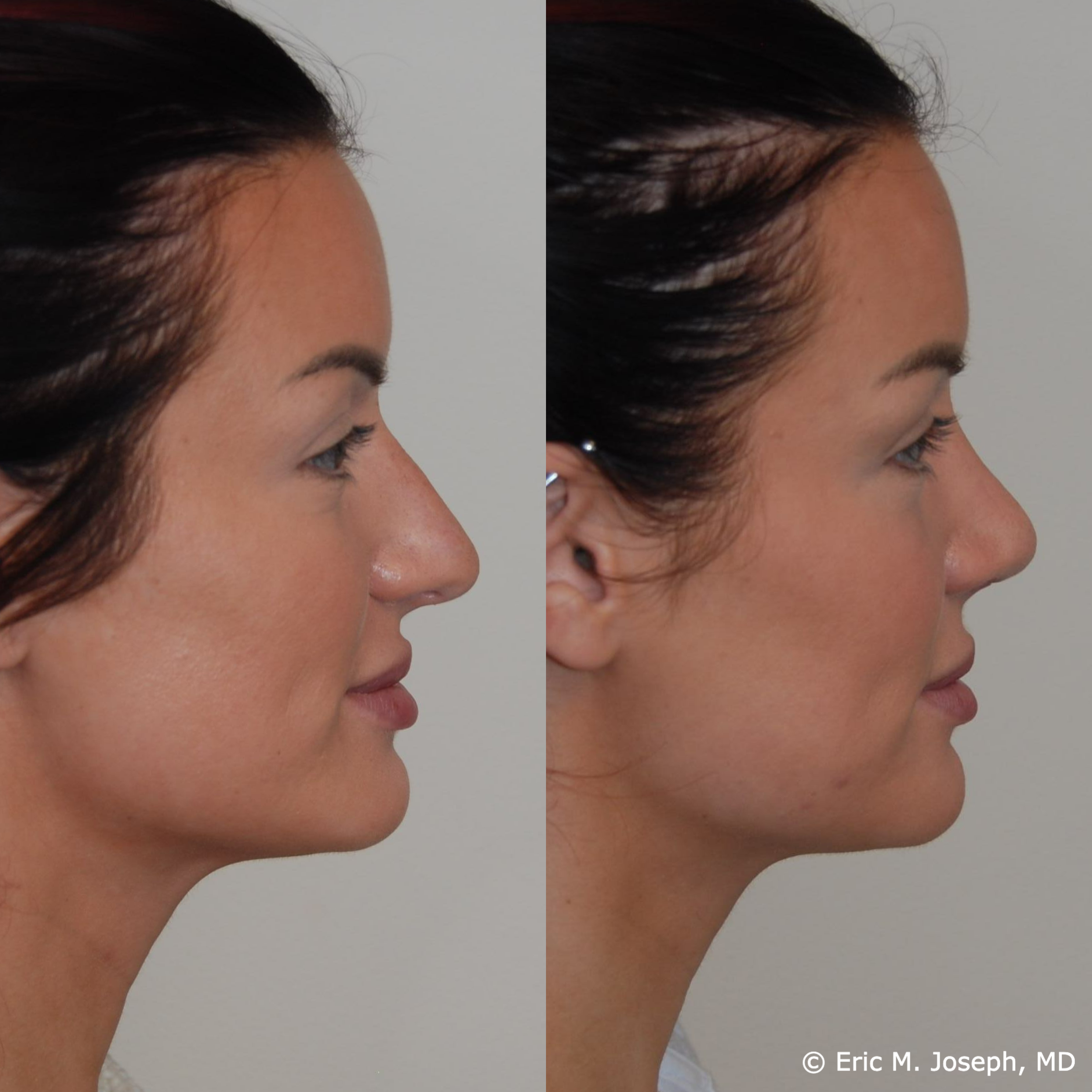 primary-rhinoplasty-nj677.png