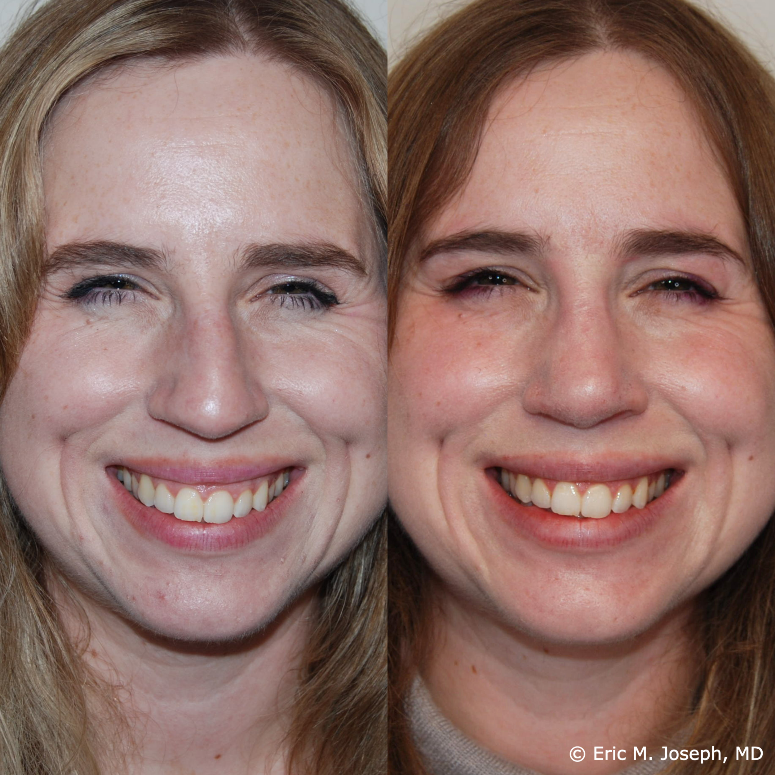 primary-rhonplasty-nj79.png