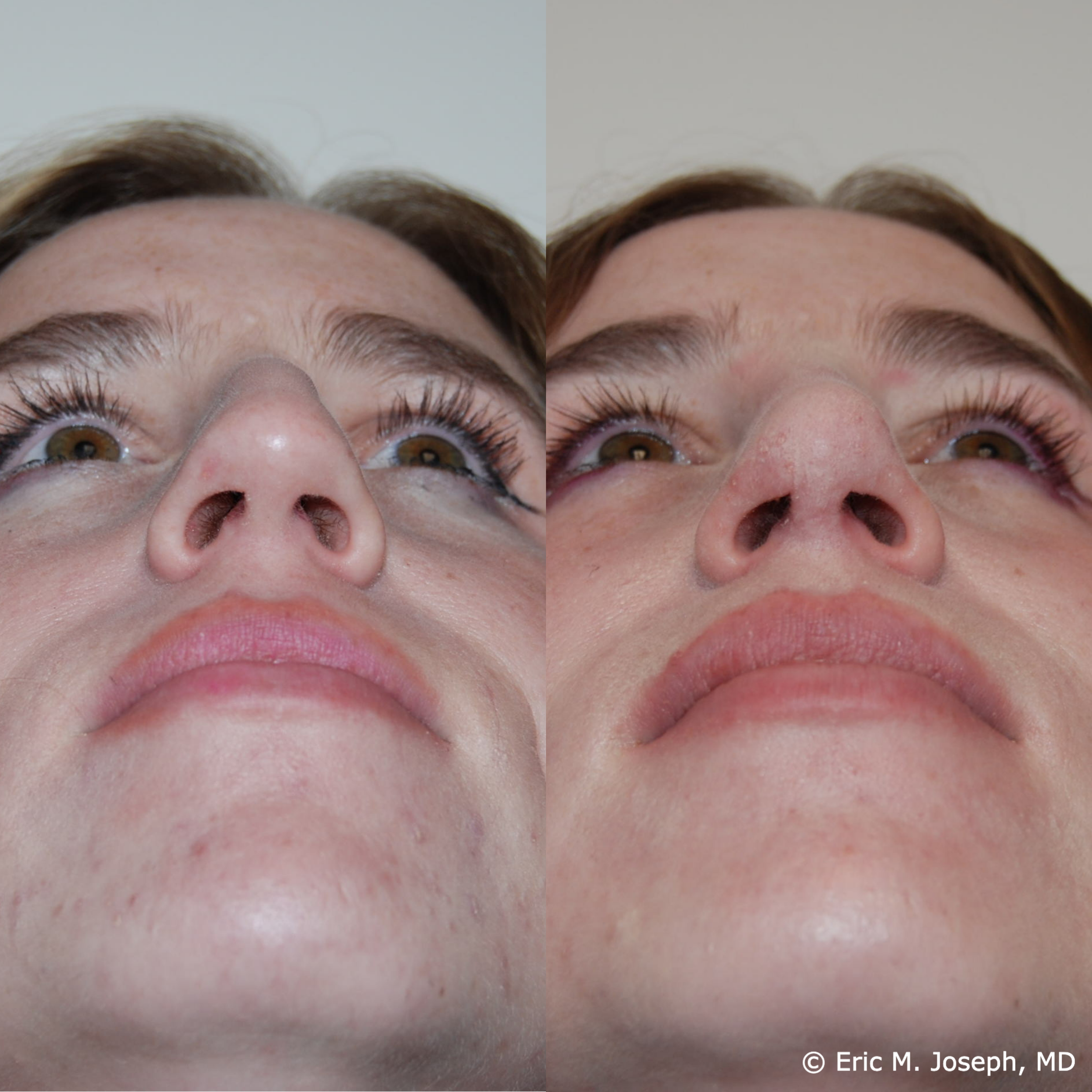 primary-rhonplasty-nj80.png