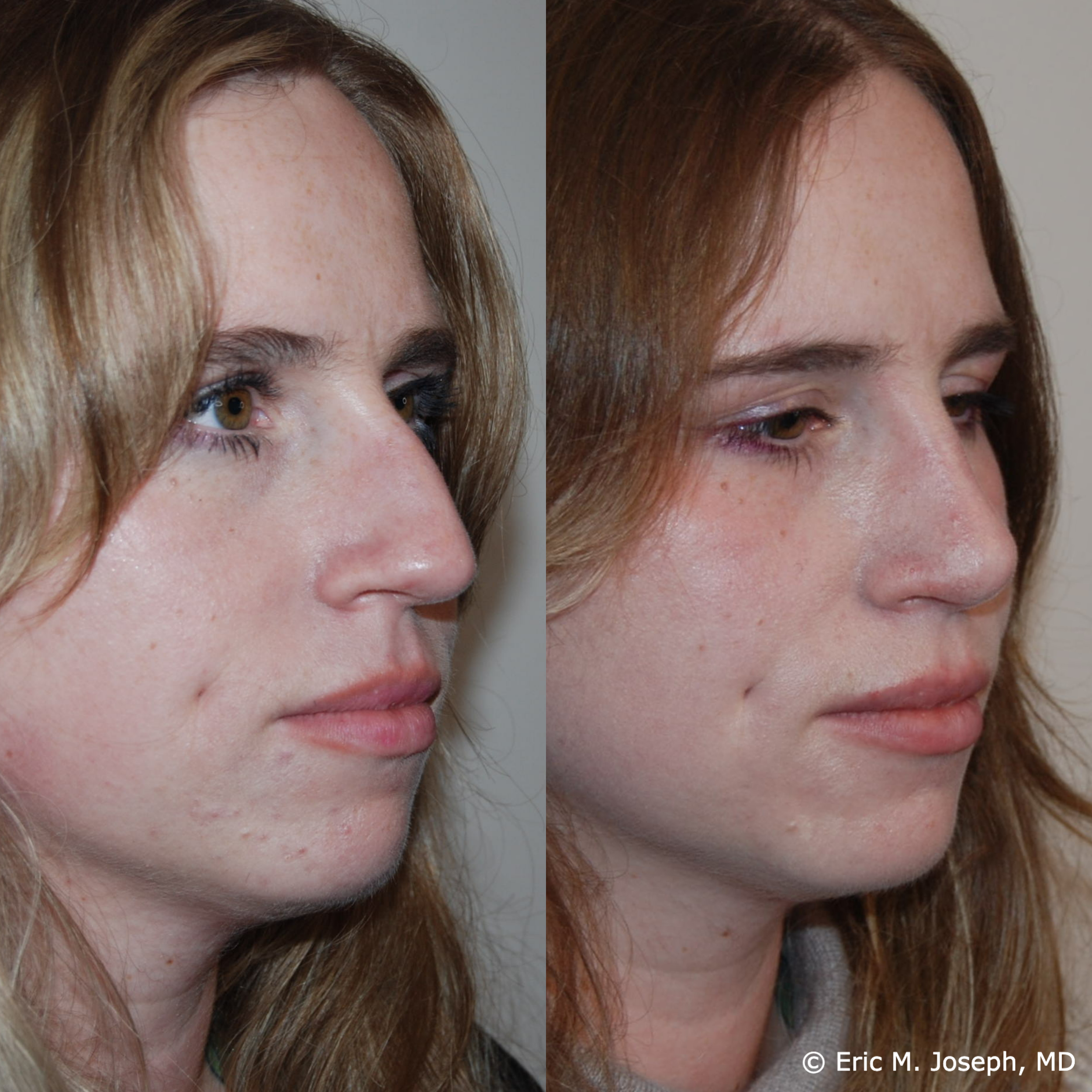primary-rhonplasty-nj81.png