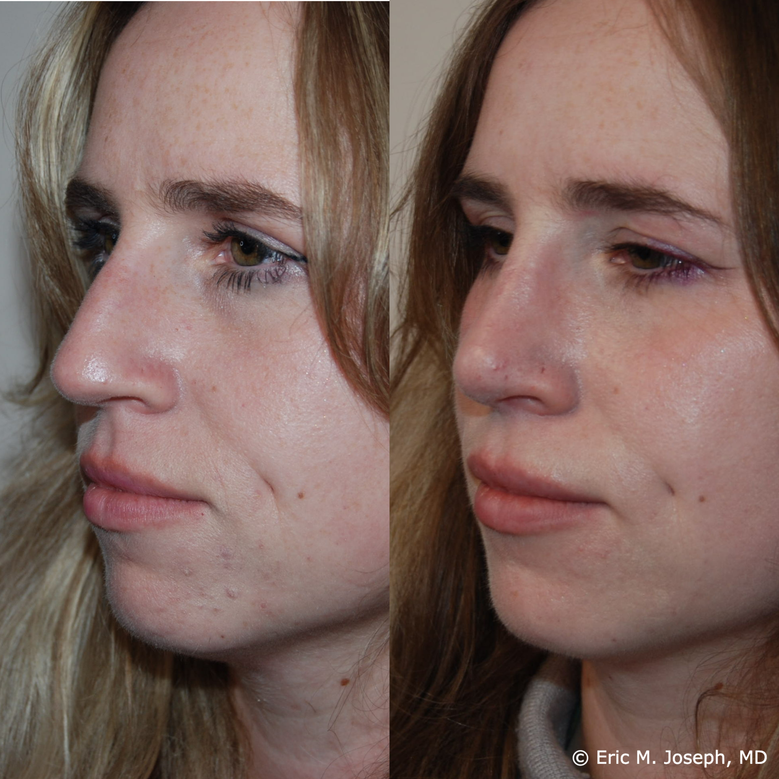 primary-rhonplasty-nj82.png