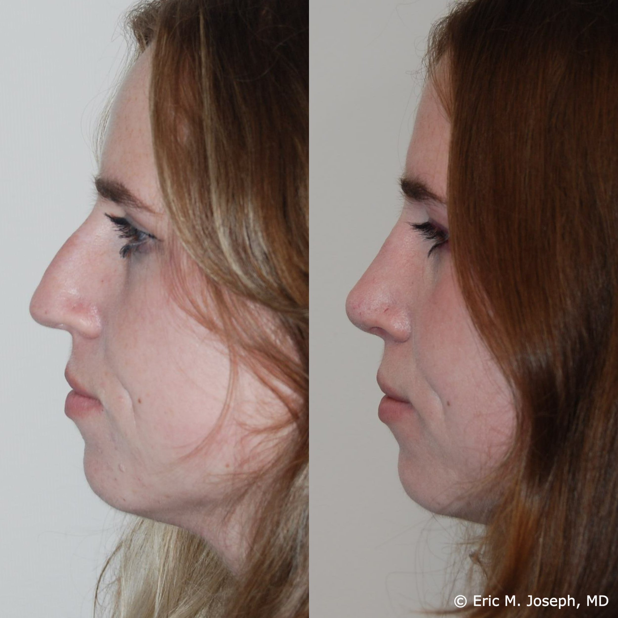 primary-rhonplasty-nj83.png