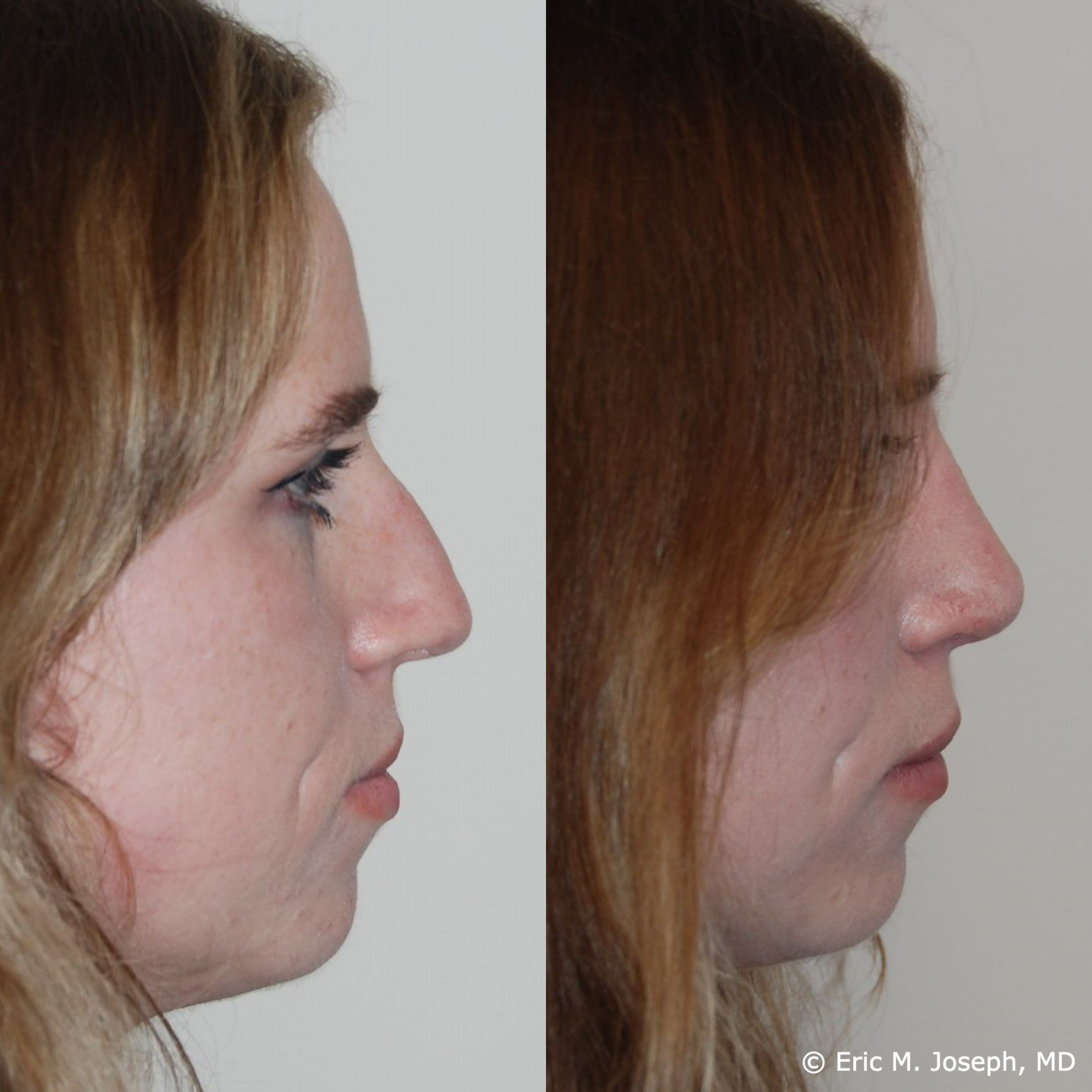 primary-rhonplasty-nj84.png