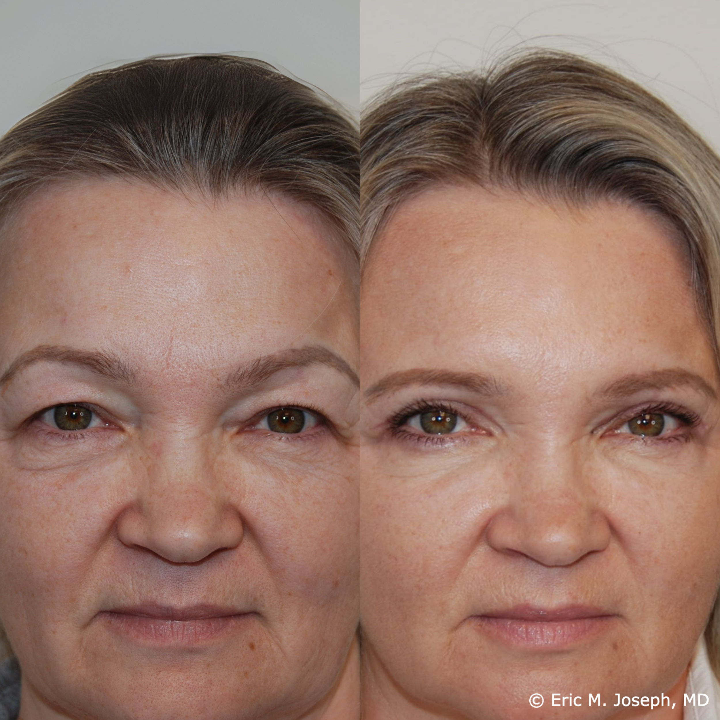 Blepharoplasty-0029.png
