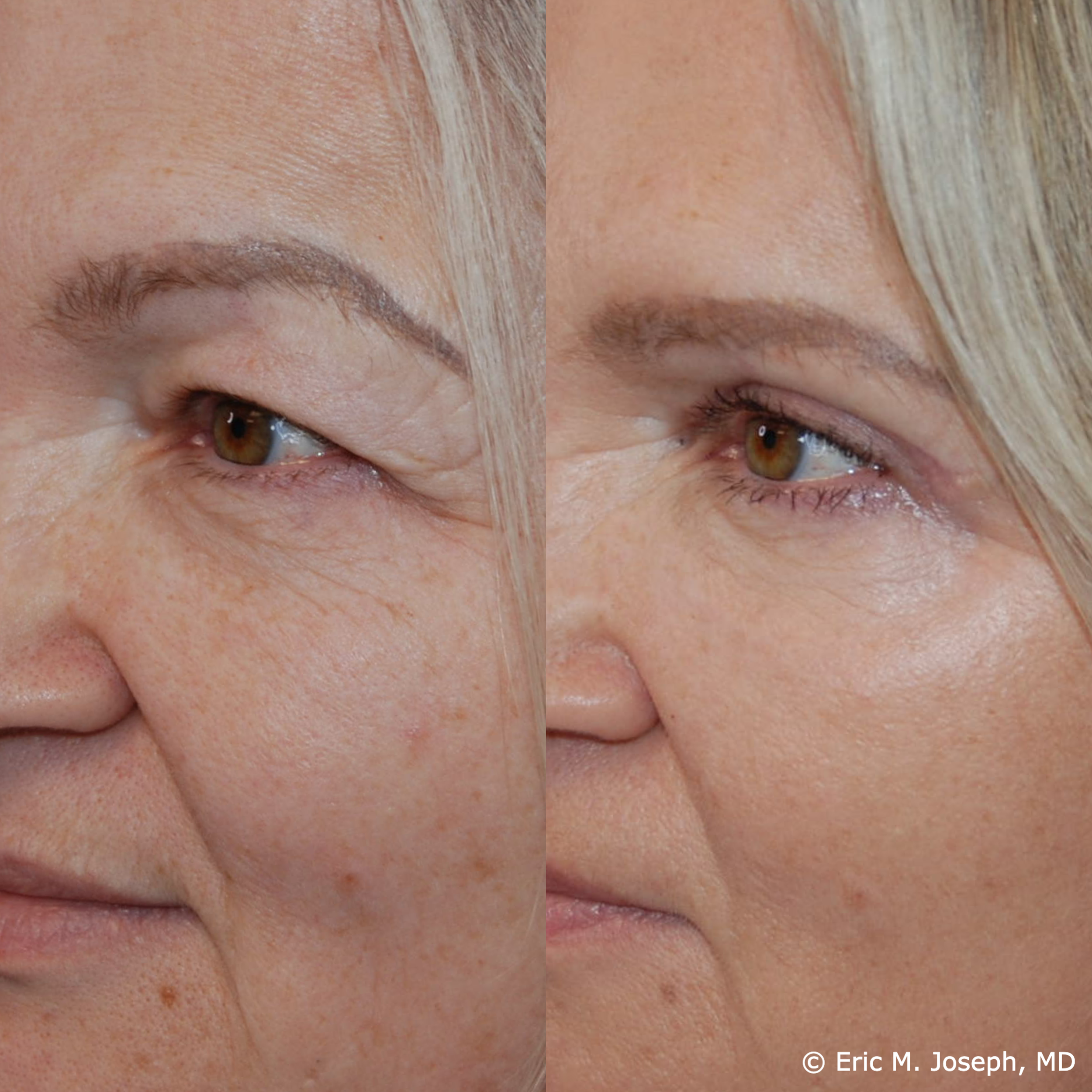 Blepharoplasty-0031.png