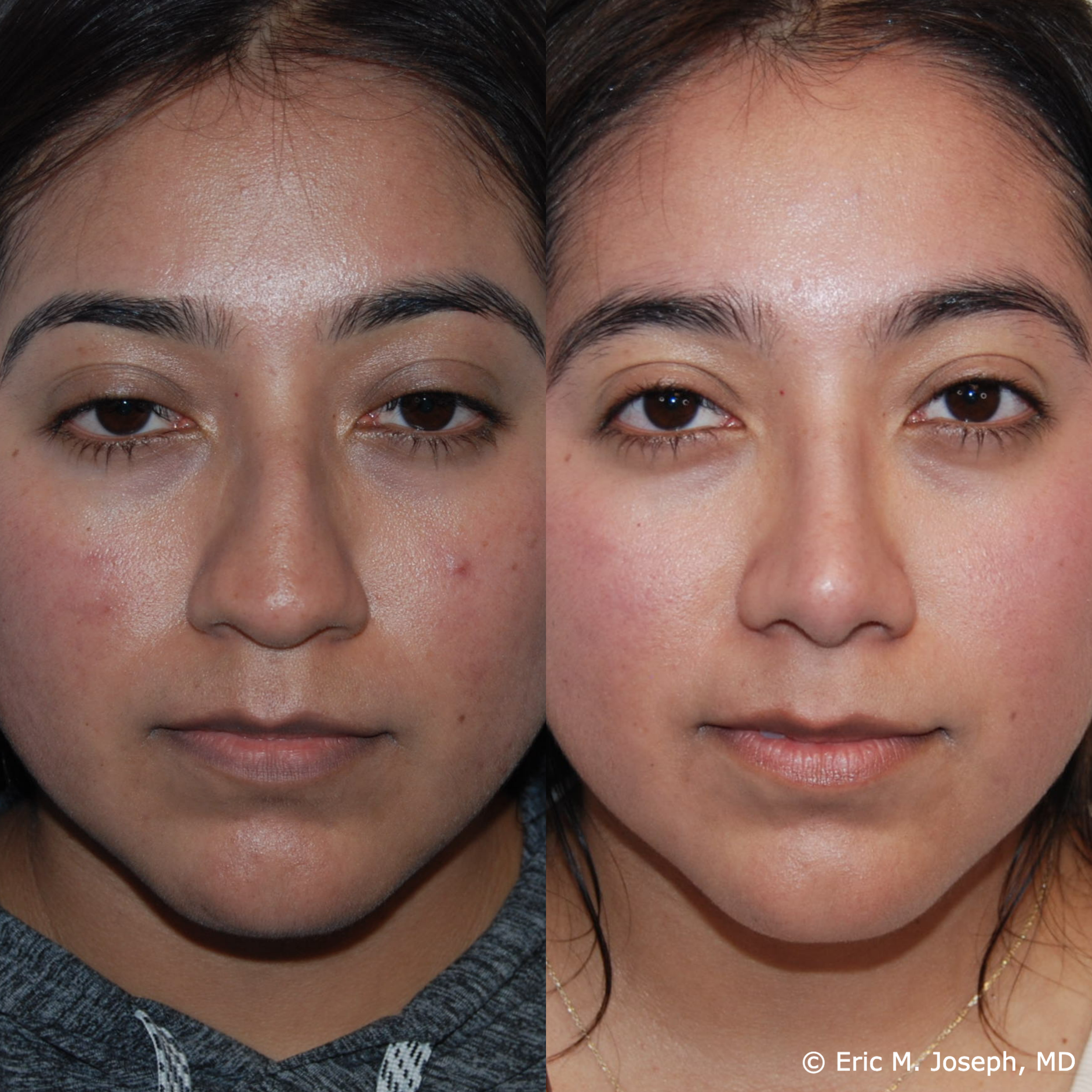 primary-rhinoplasty-nj678.png