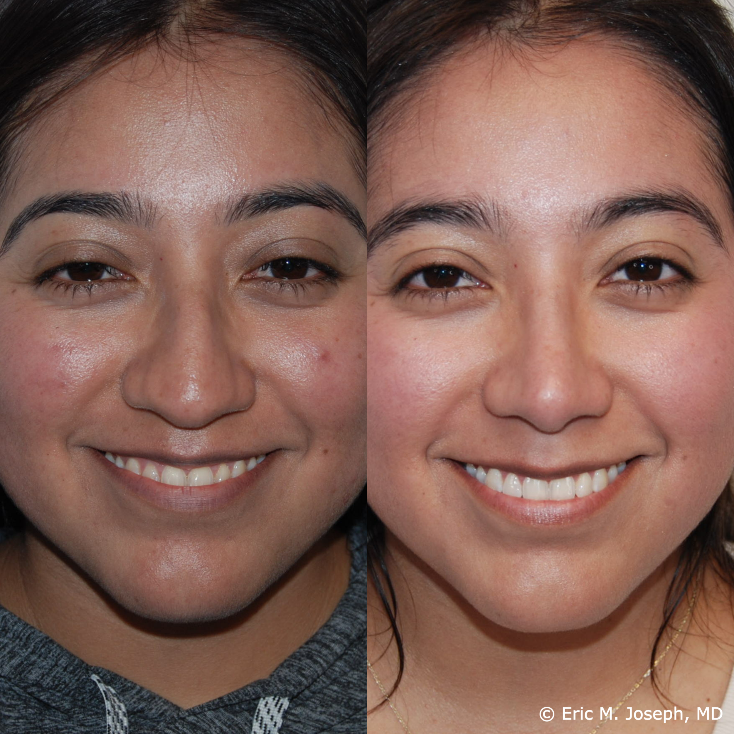 primary-rhinoplasty-nj679.png