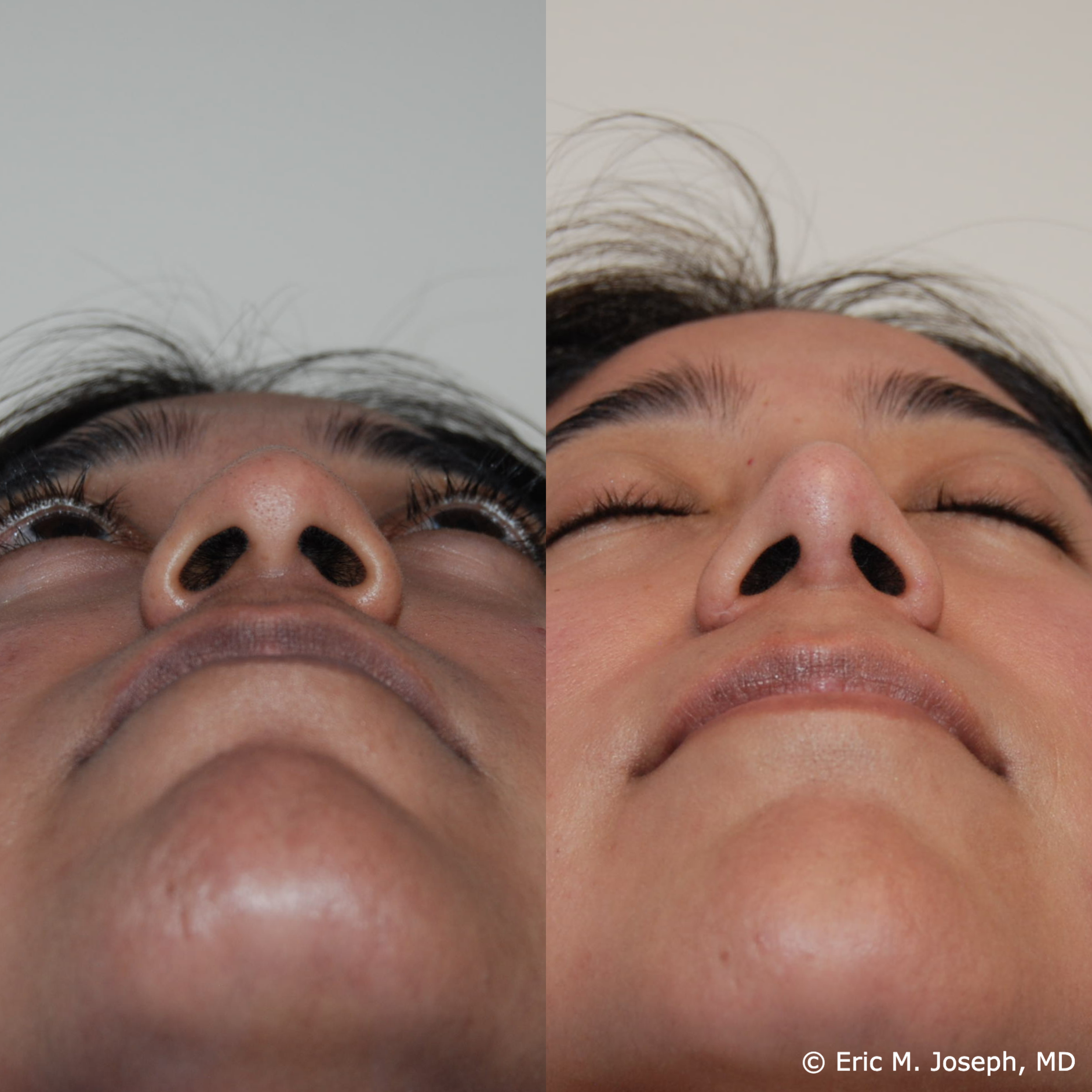 primary-rhinoplasty-nj680.png