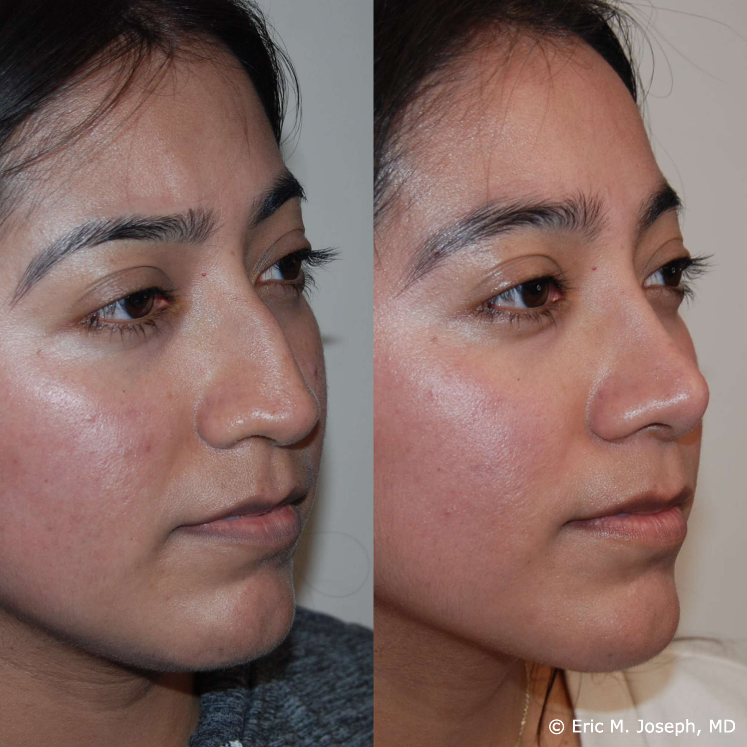 primary-rhinoplasty-nj681.png