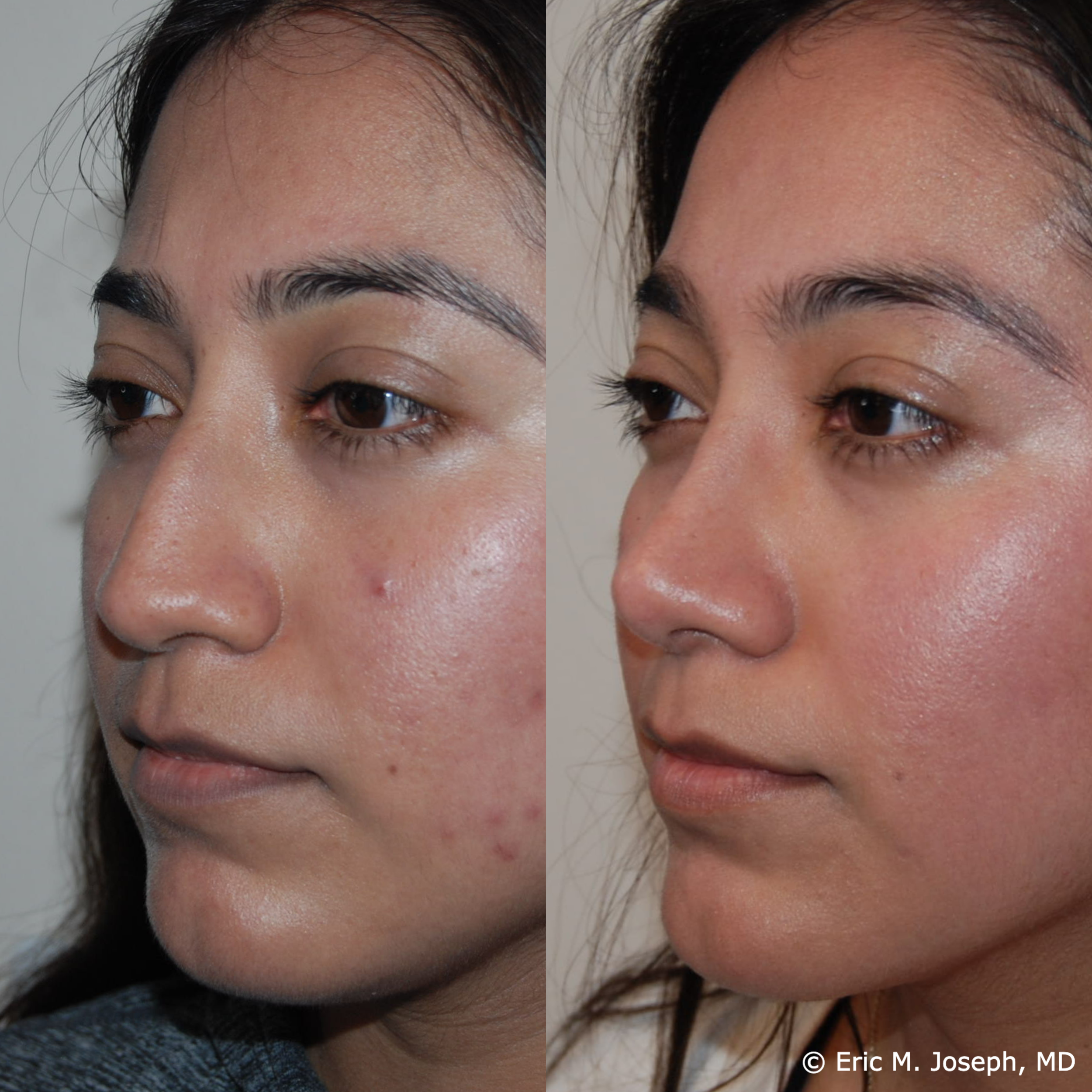 primary-rhinoplasty-nj682.png