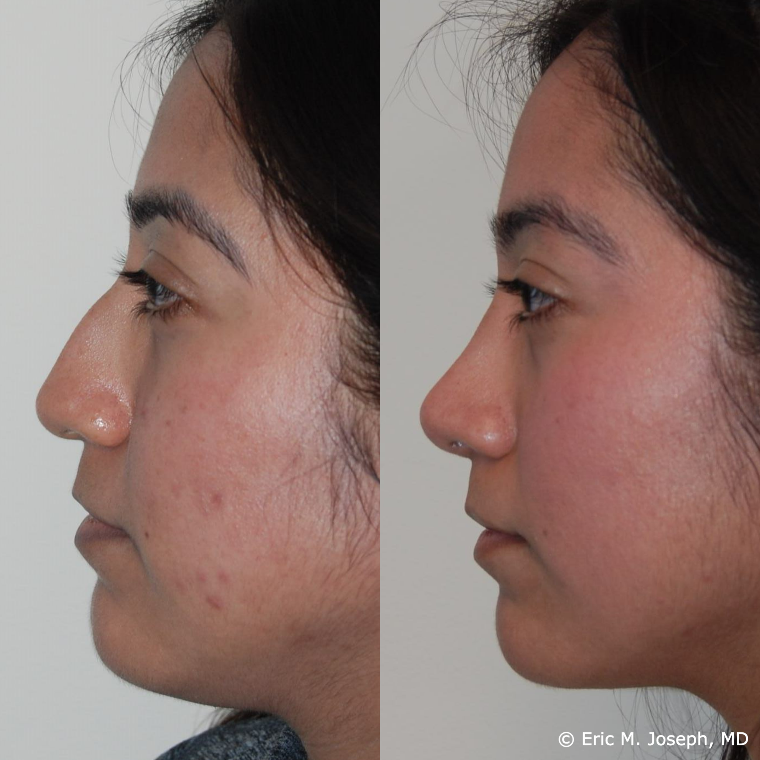 primary-rhinoplasty-nj683.png