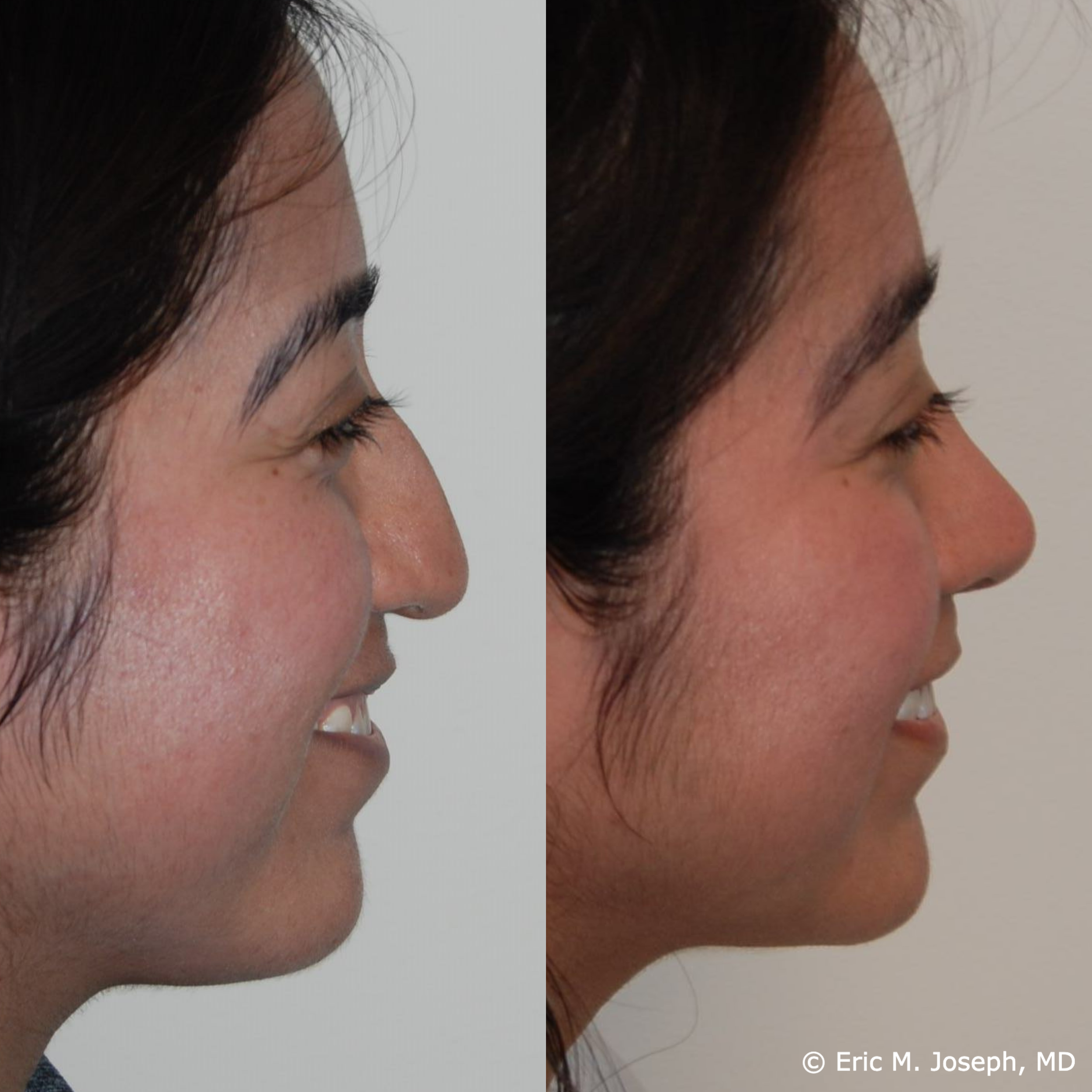 primary-rhinoplasty-nj685.png